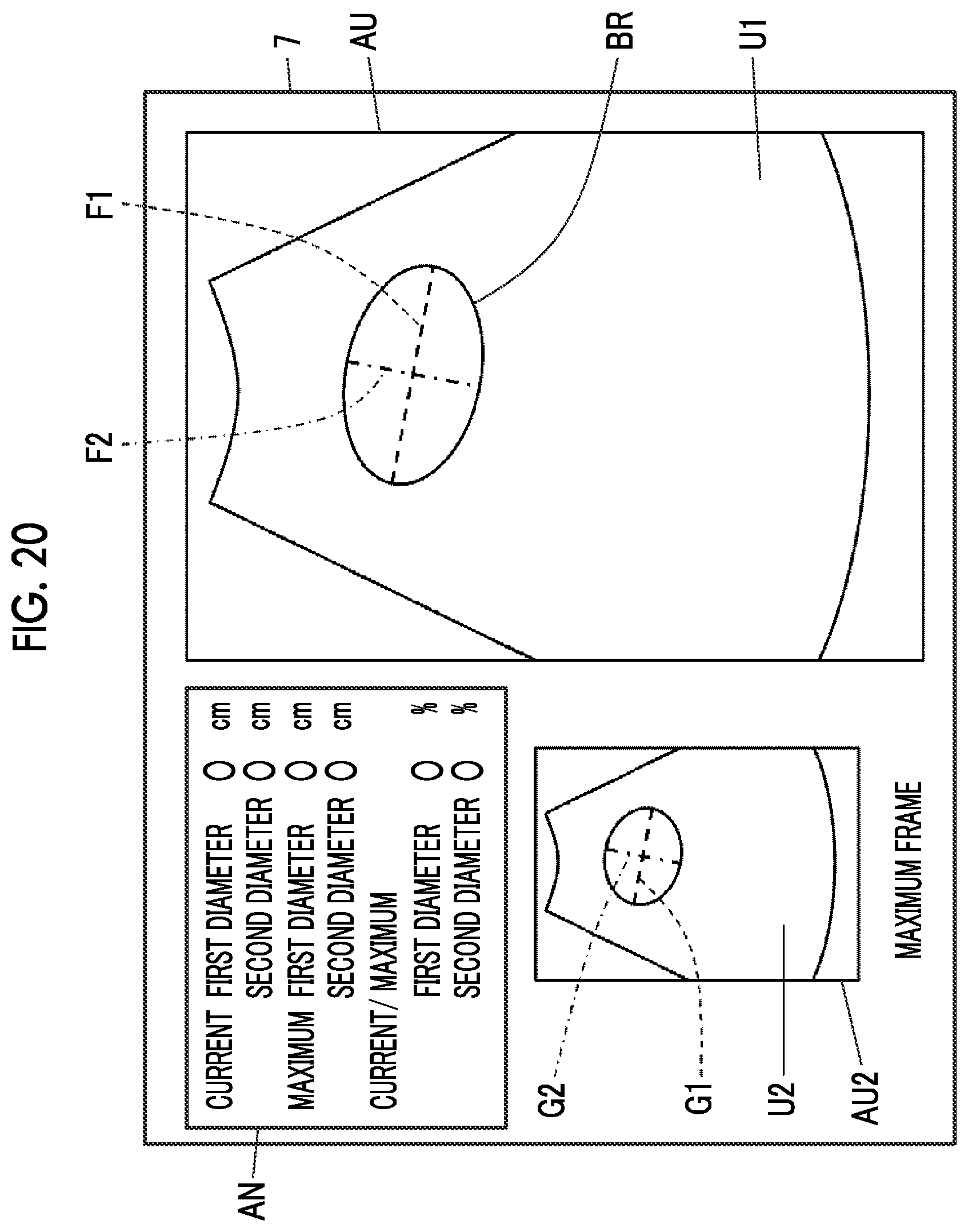 Patent US12611190 Figure 16 – Ultrasound diagnostic apparatus and control method of ultrasound diagnostic apparatus for measuring a volume of a bladder of a subject