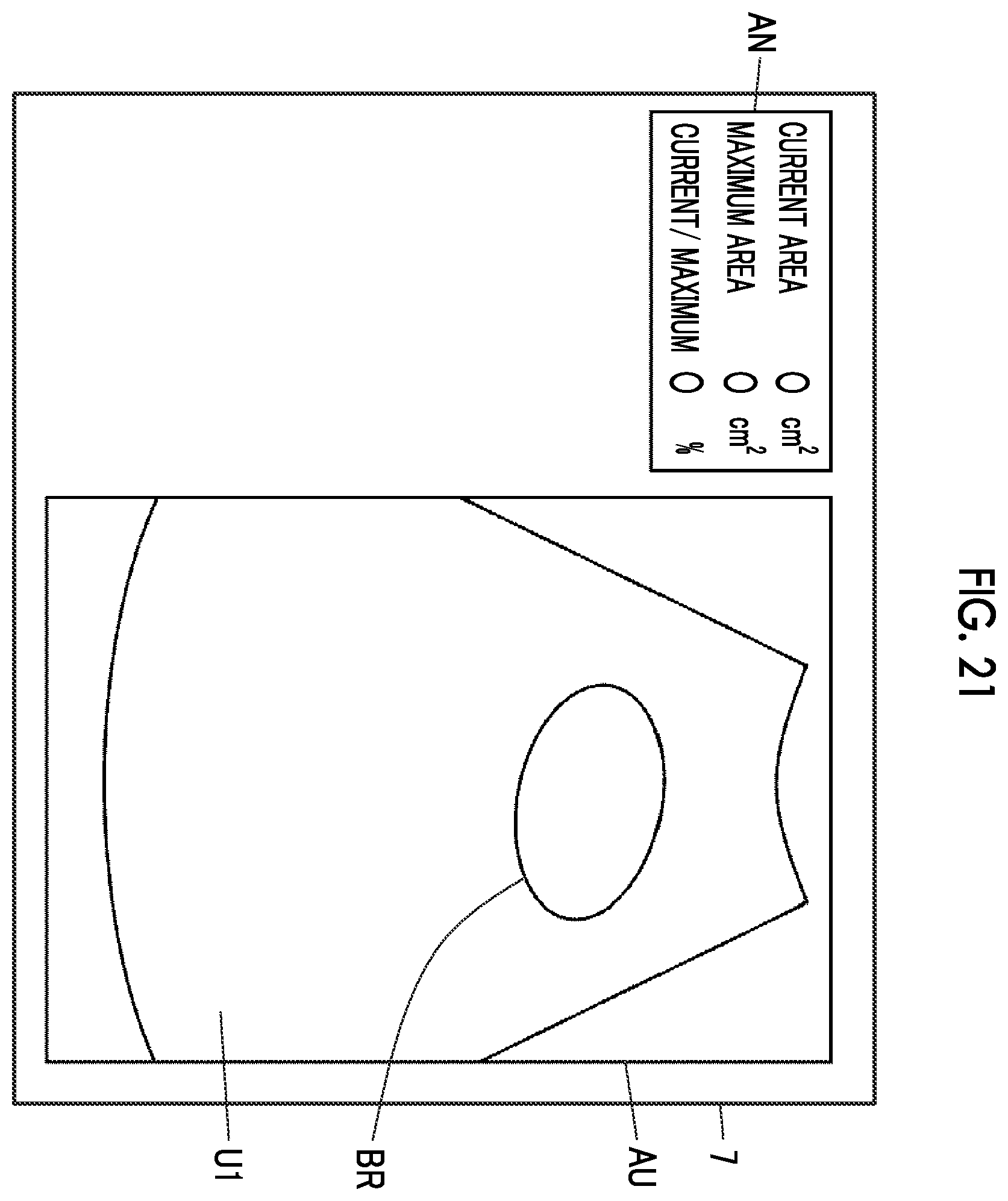 Patent US12611190 Figure 17 – Ultrasound diagnostic apparatus and control method of ultrasound diagnostic apparatus for measuring a volume of a bladder of a subject
