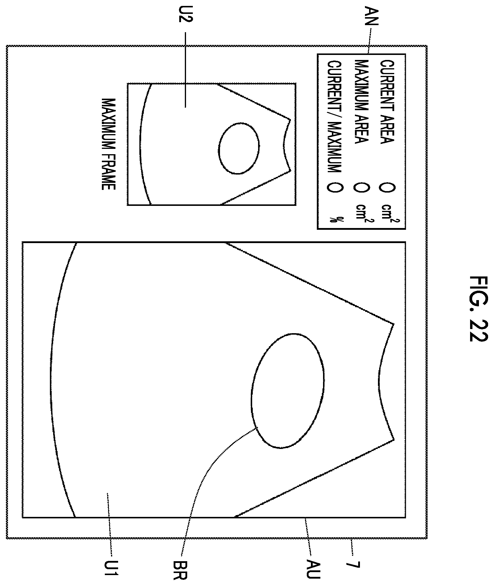 Patent US12611190 Figure 18 – Ultrasound diagnostic apparatus and control method of ultrasound diagnostic apparatus for measuring a volume of a bladder of a subject