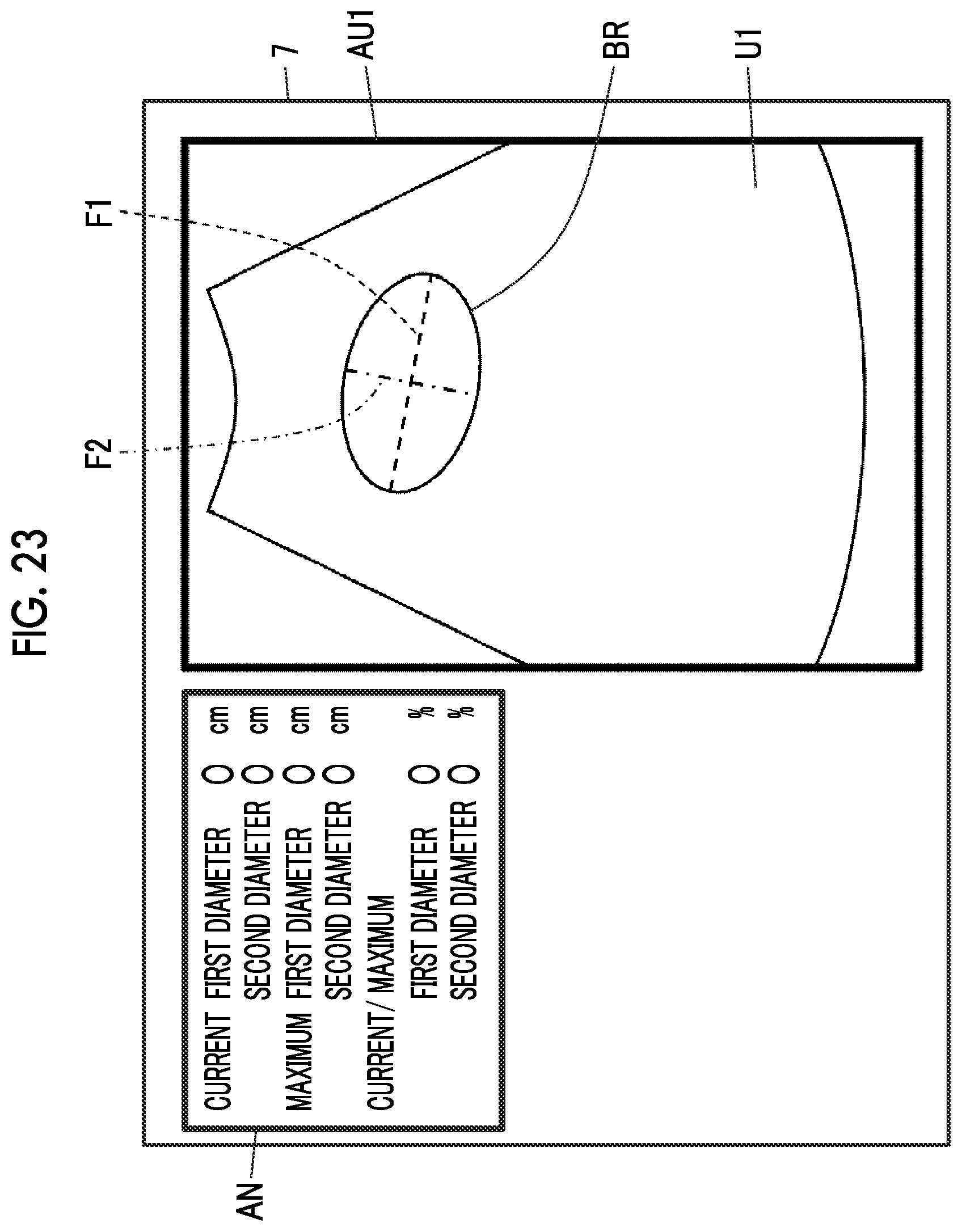 Patent US12611190 Figure 19 – Ultrasound diagnostic apparatus and control method of ultrasound diagnostic apparatus for measuring a volume of a bladder of a subject