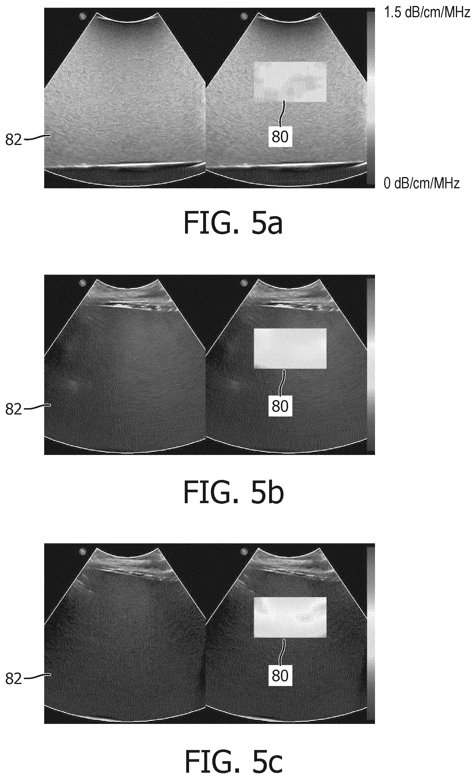 Patent US12611196 Figure 5 – Ultrasonic quantification of acoustic attenuation coefficient in the presence of elevation aperture blockage