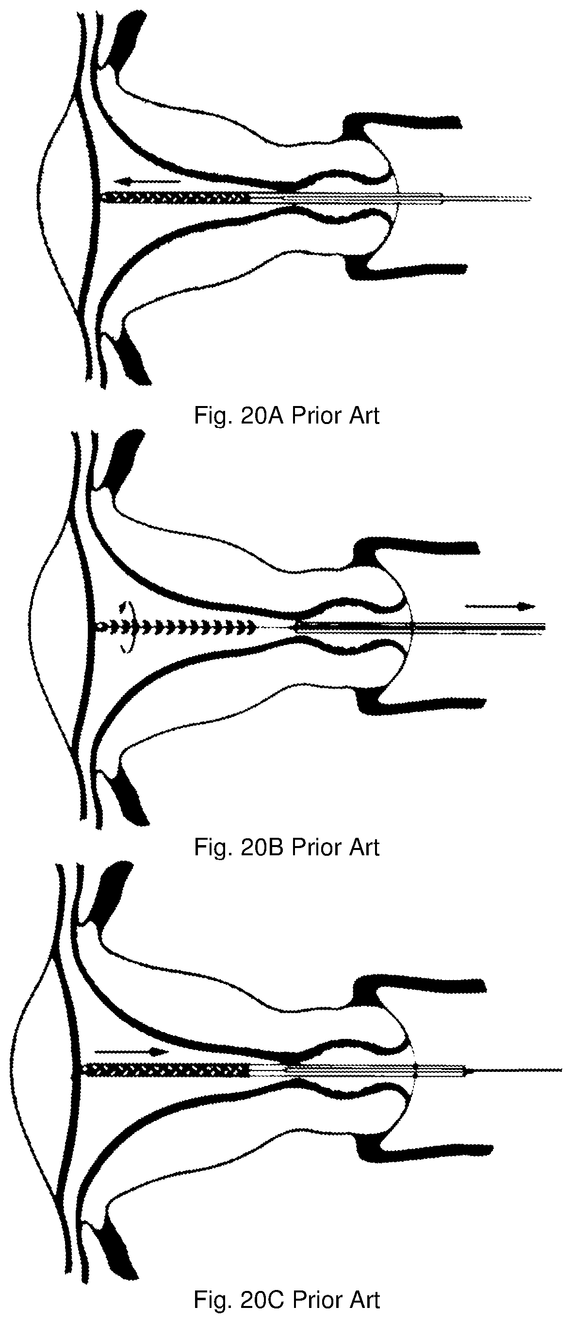 Patent US12611201 Figure 5 – Absorptive tip brush biopsy device, kit and method