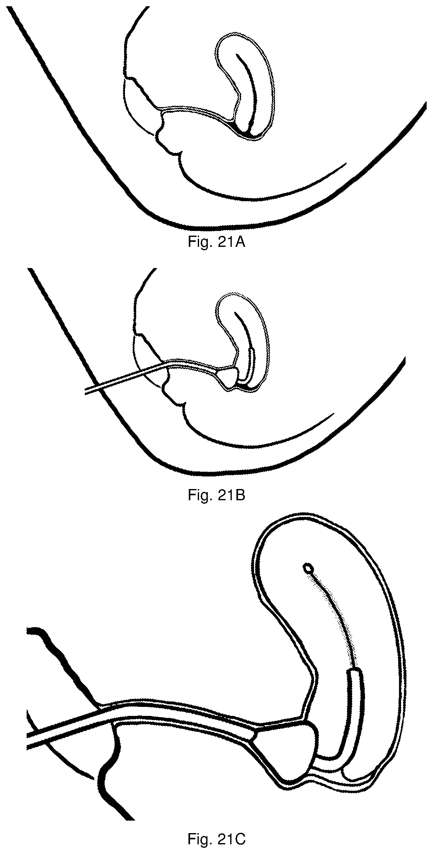 Patent US12611201 Figure 6 – Absorptive tip brush biopsy device, kit and method