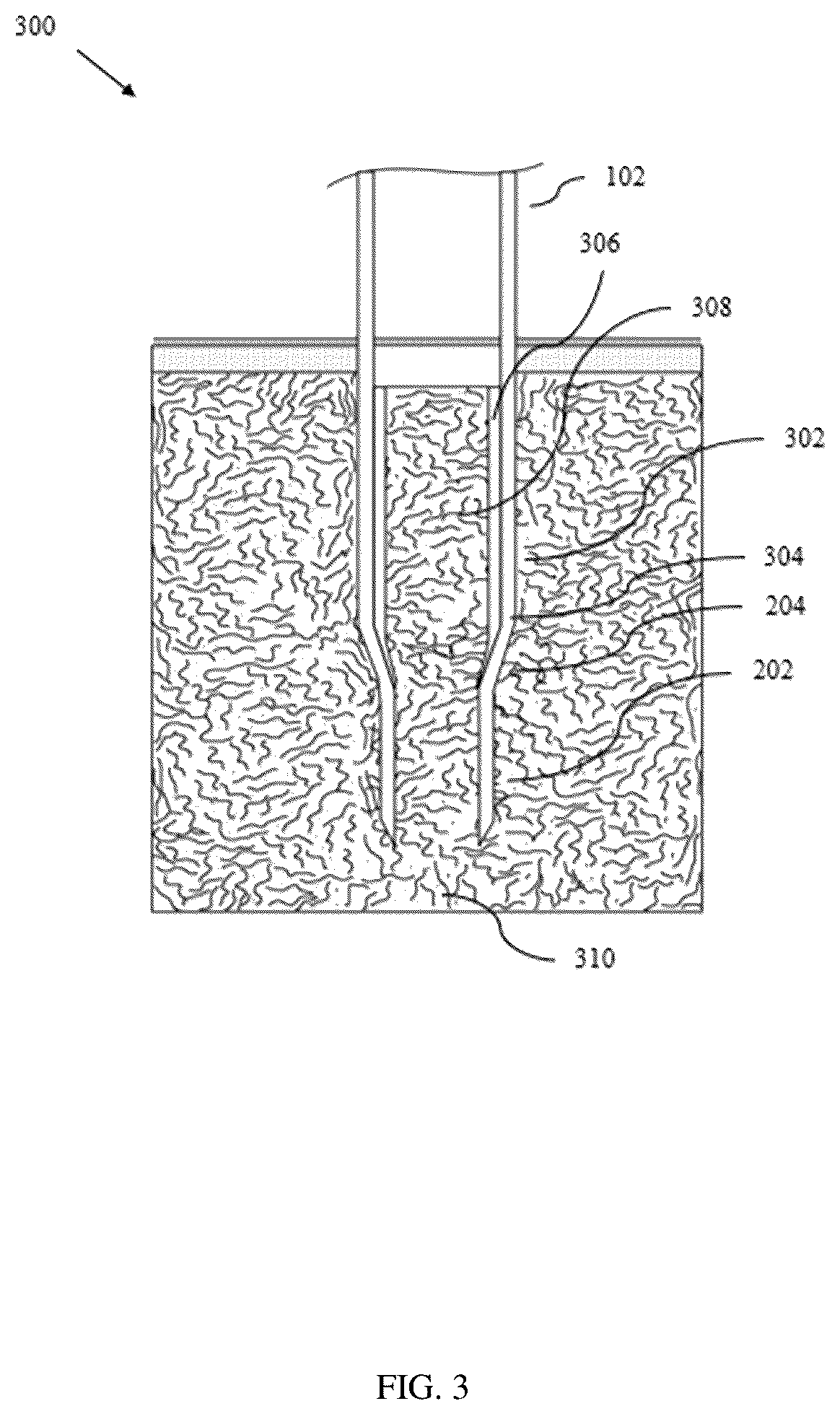 Patent US12611204 Figure 3 – Bone marrow aspiration and trephine biopsy single needle assembly