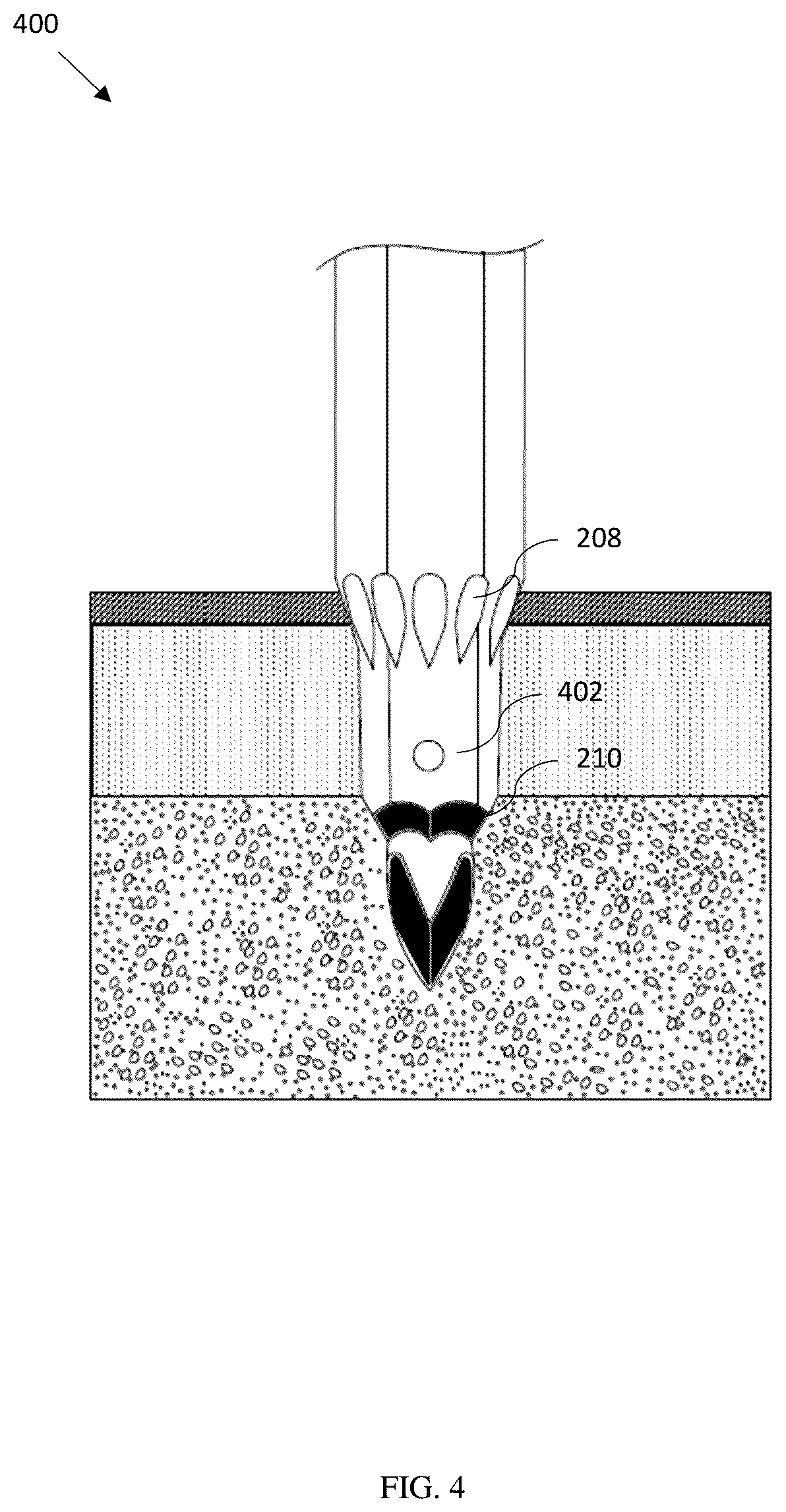 Patent US12611204 Figure 4 – Bone marrow aspiration and trephine biopsy single needle assembly