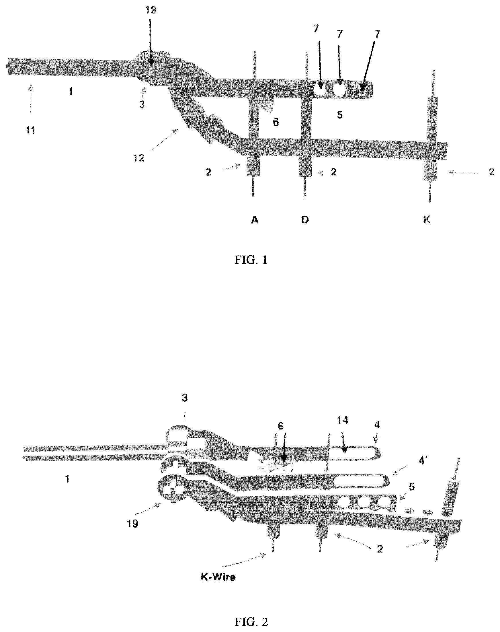 Patent US12611218 Figure 1 – Device for tension band wiring fixation of fractures, particularly of olecranon, and olecranon osteotomy and method therefor