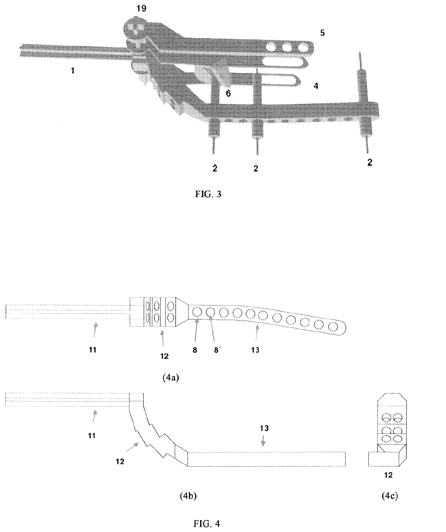 Patent US12611218 Figure 2 – Device for tension band wiring fixation of fractures, particularly of olecranon, and olecranon osteotomy and method therefor