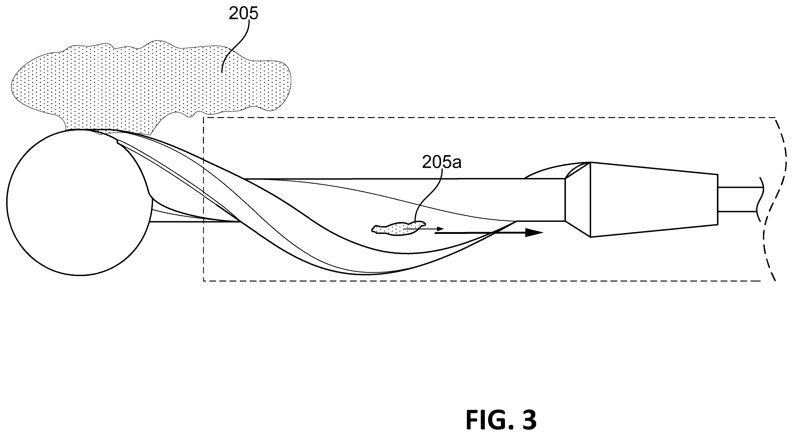 Patent US12611224 Figure 3 – Vascular occlusion detection from motorized separator torque measurement signal