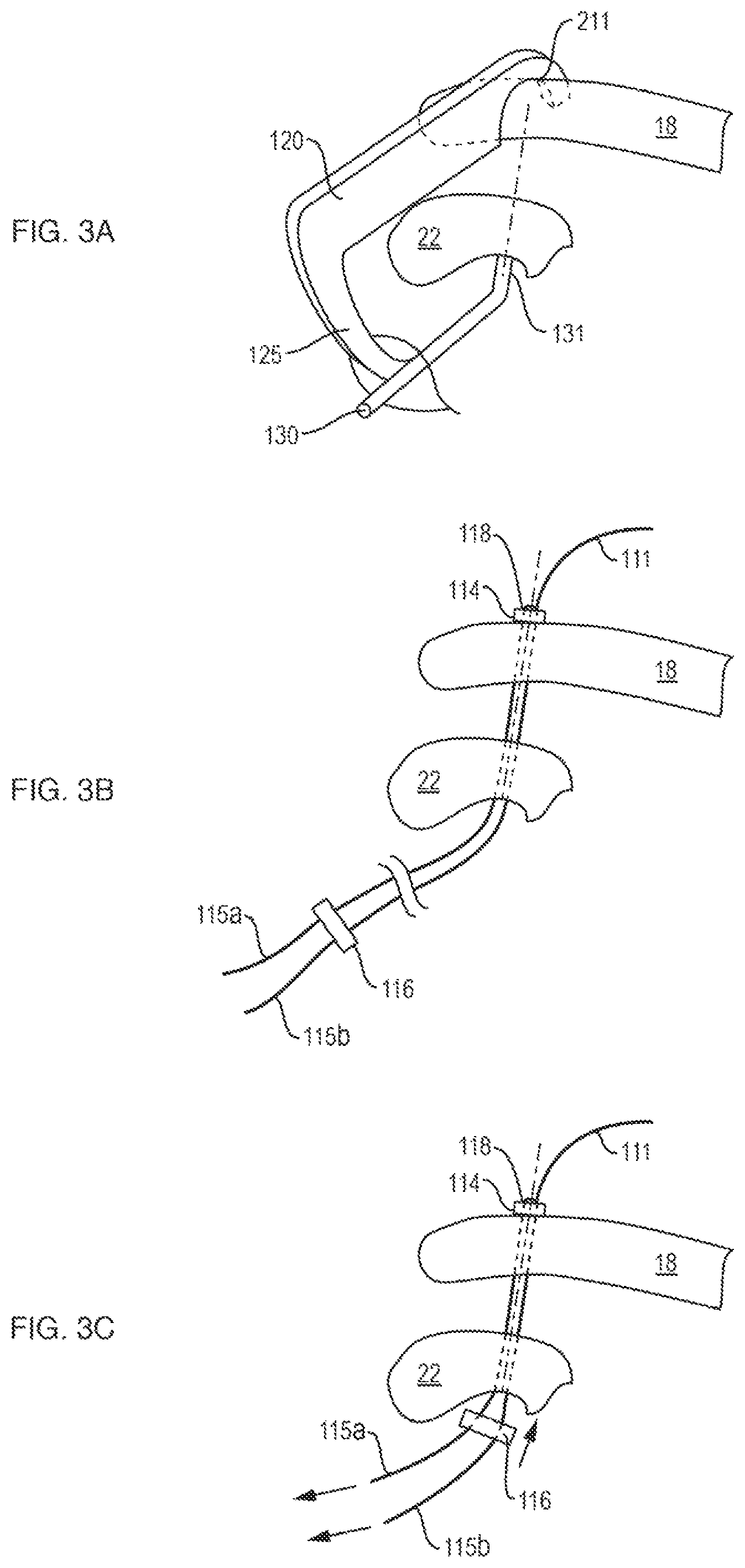 Patent US12611230 Figure 3 – Methods and systems related to joint repair