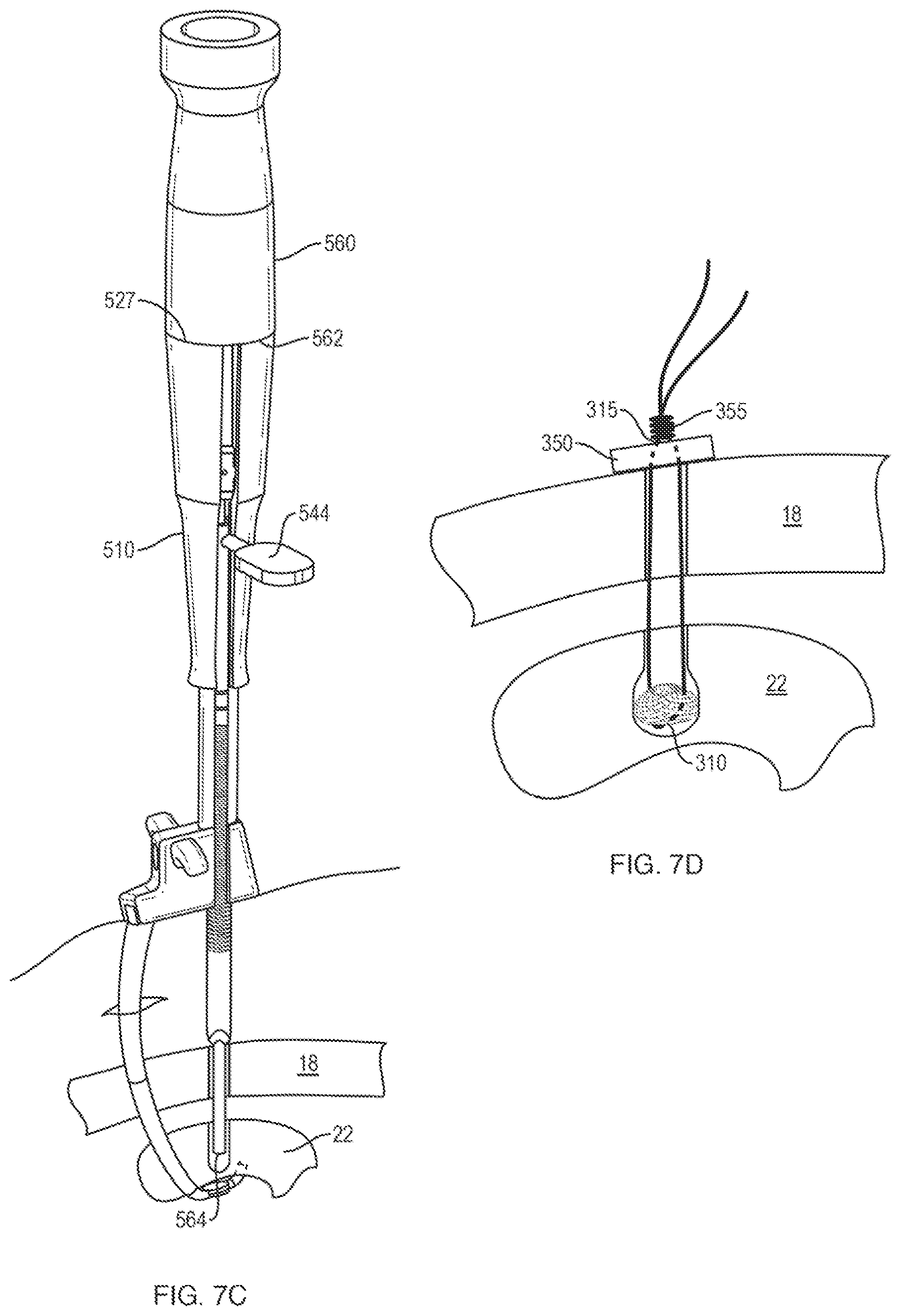 Patent US12611230 Figure 11 – Methods and systems related to joint repair