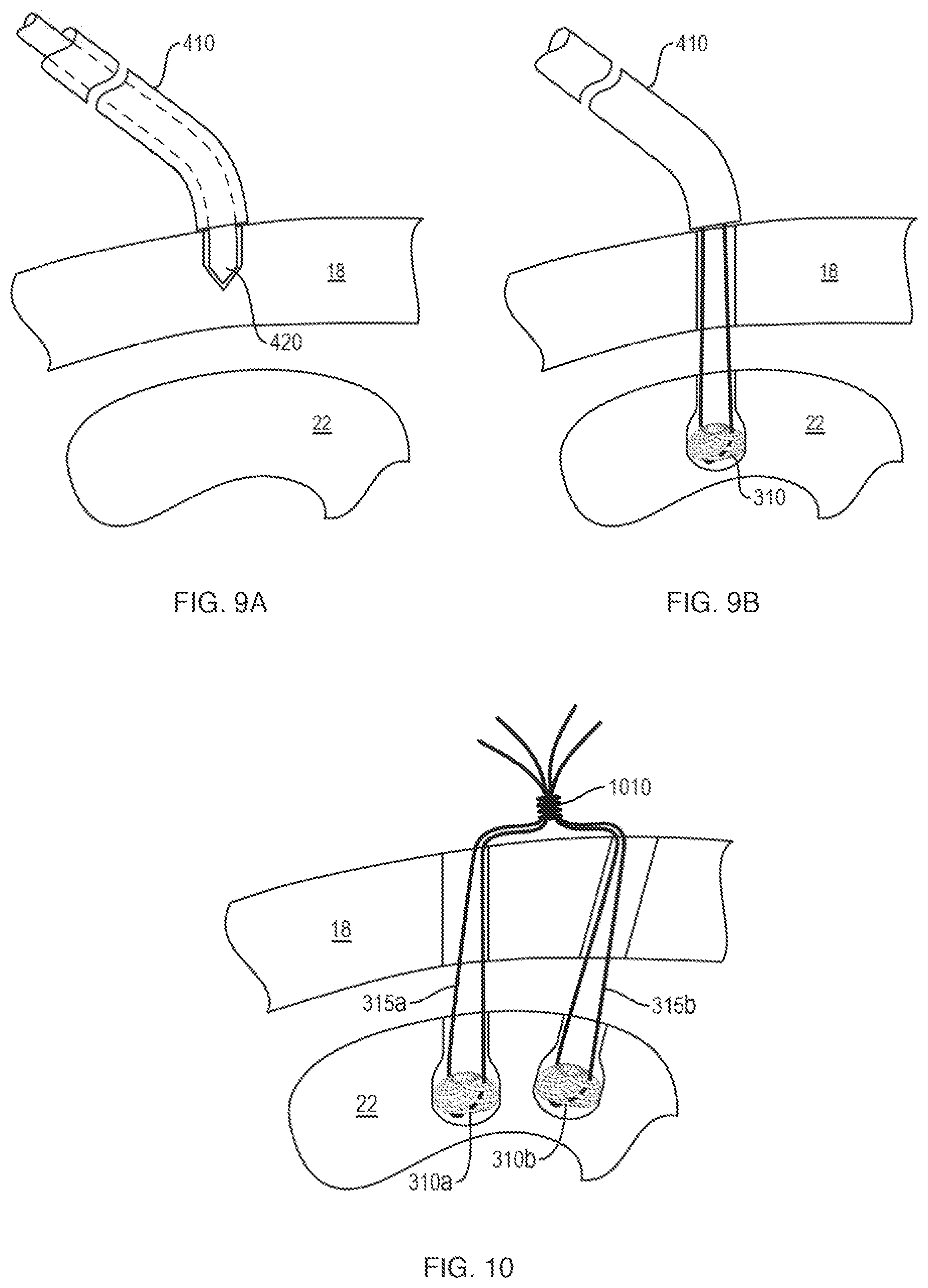 Patent US12611230 Figure 14 – Methods and systems related to joint repair