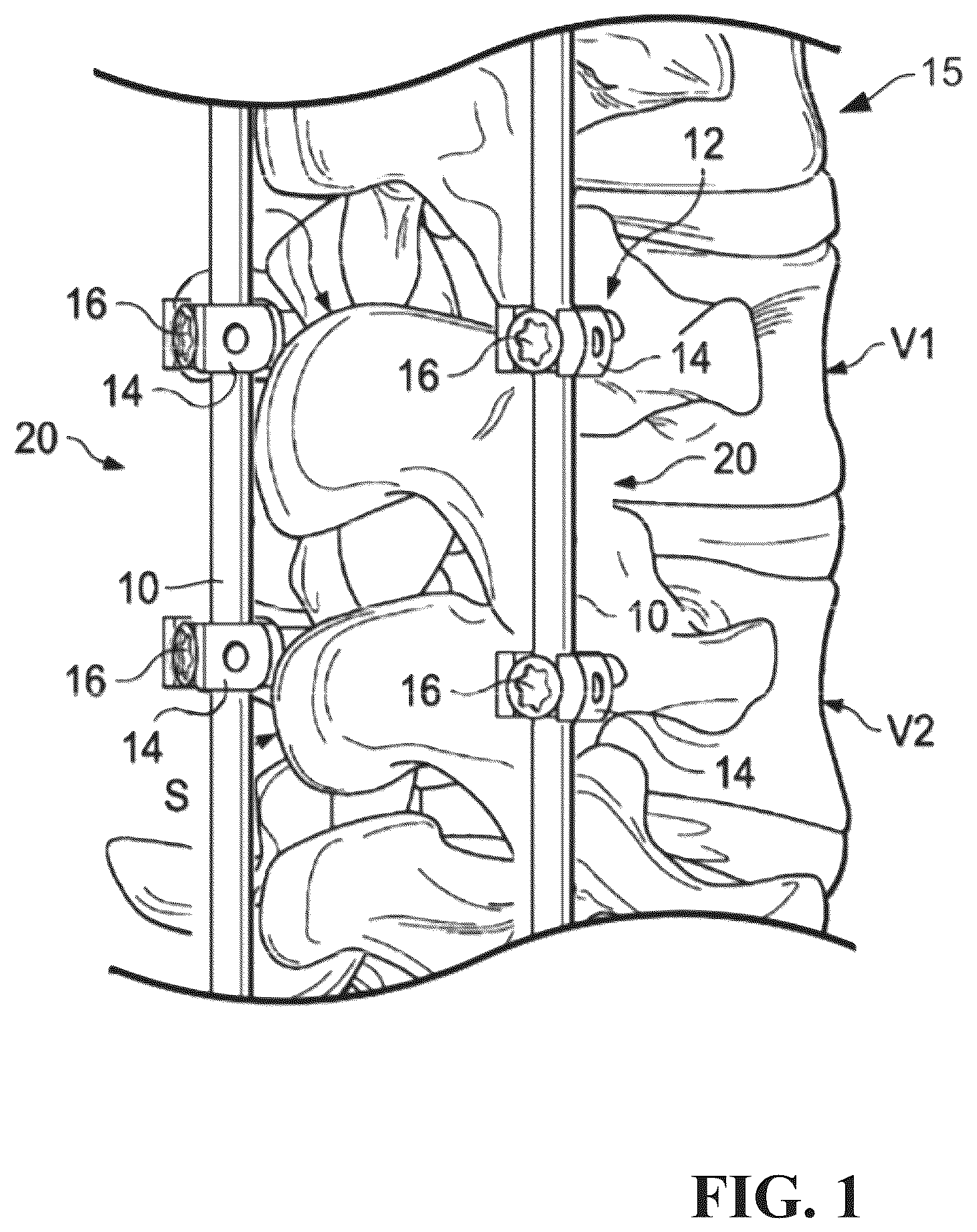 Patent US12611231 — Spinal rod and systems thereof — Figure 1
