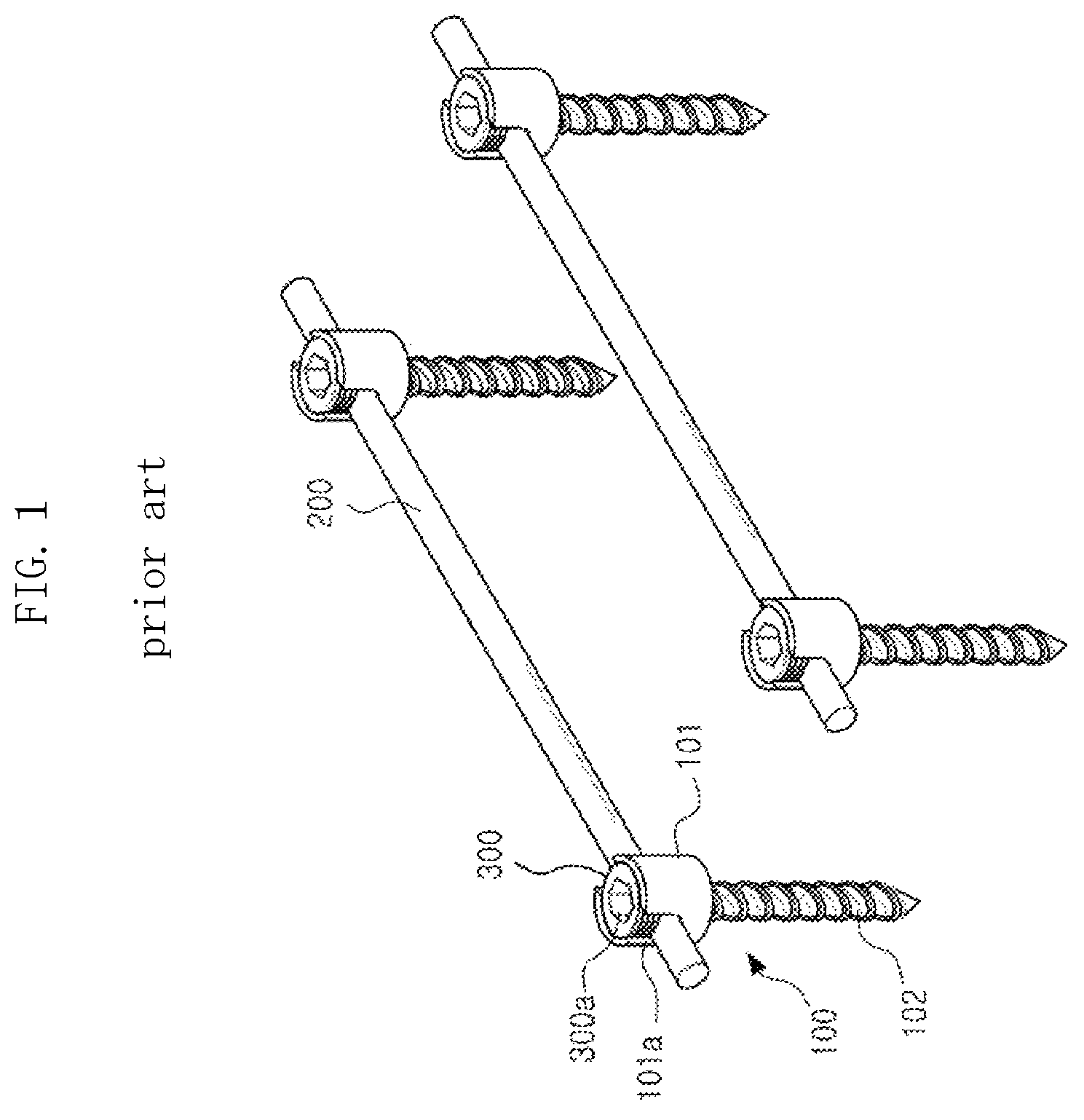 Patent US12611232 Figure 1 – Bio-flexible spinal fixation apparatus for preventing fatigue fracture