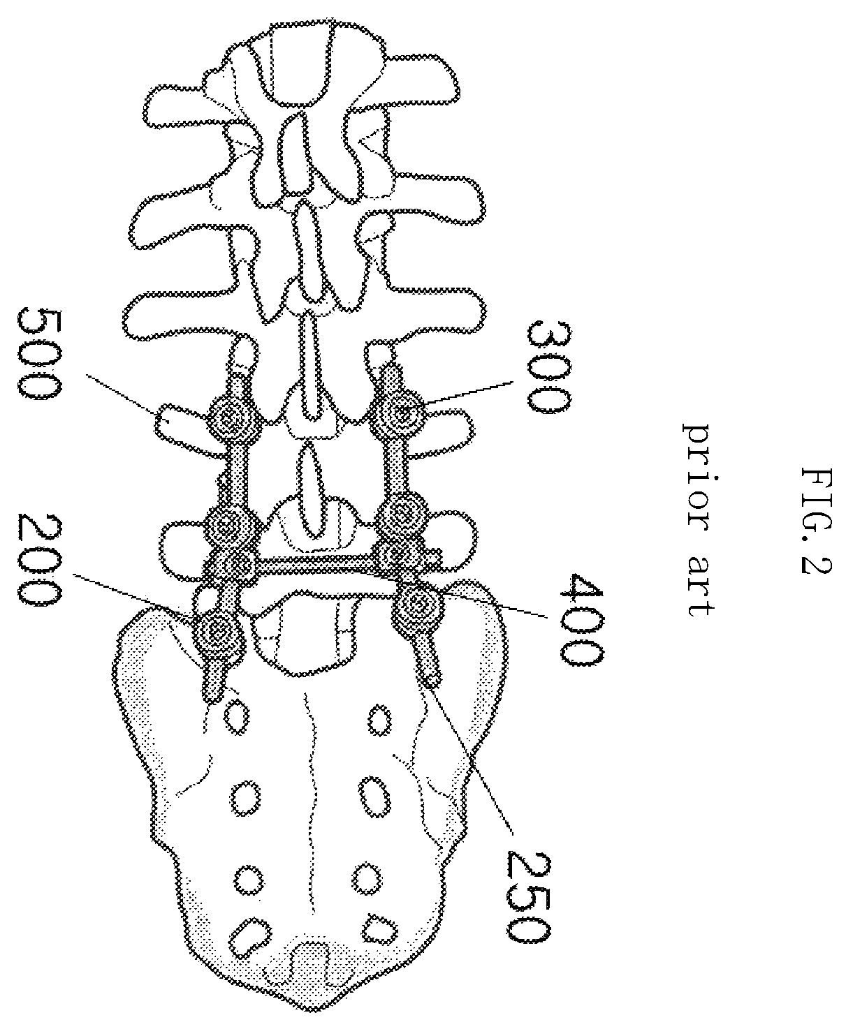 Patent US12611232 Figure 2 – Bio-flexible spinal fixation apparatus for preventing fatigue fracture