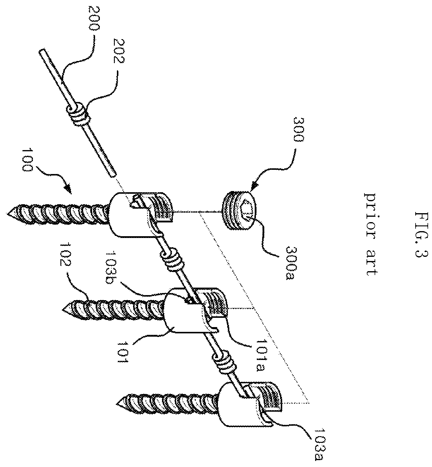 Patent US12611232 Figure 3 – Bio-flexible spinal fixation apparatus for preventing fatigue fracture