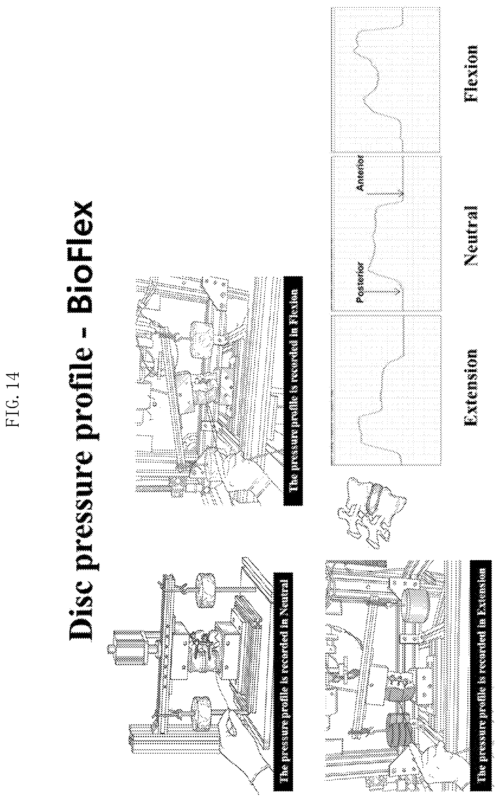 Patent US12611232 Figure 10 – Bio-flexible spinal fixation apparatus for preventing fatigue fracture