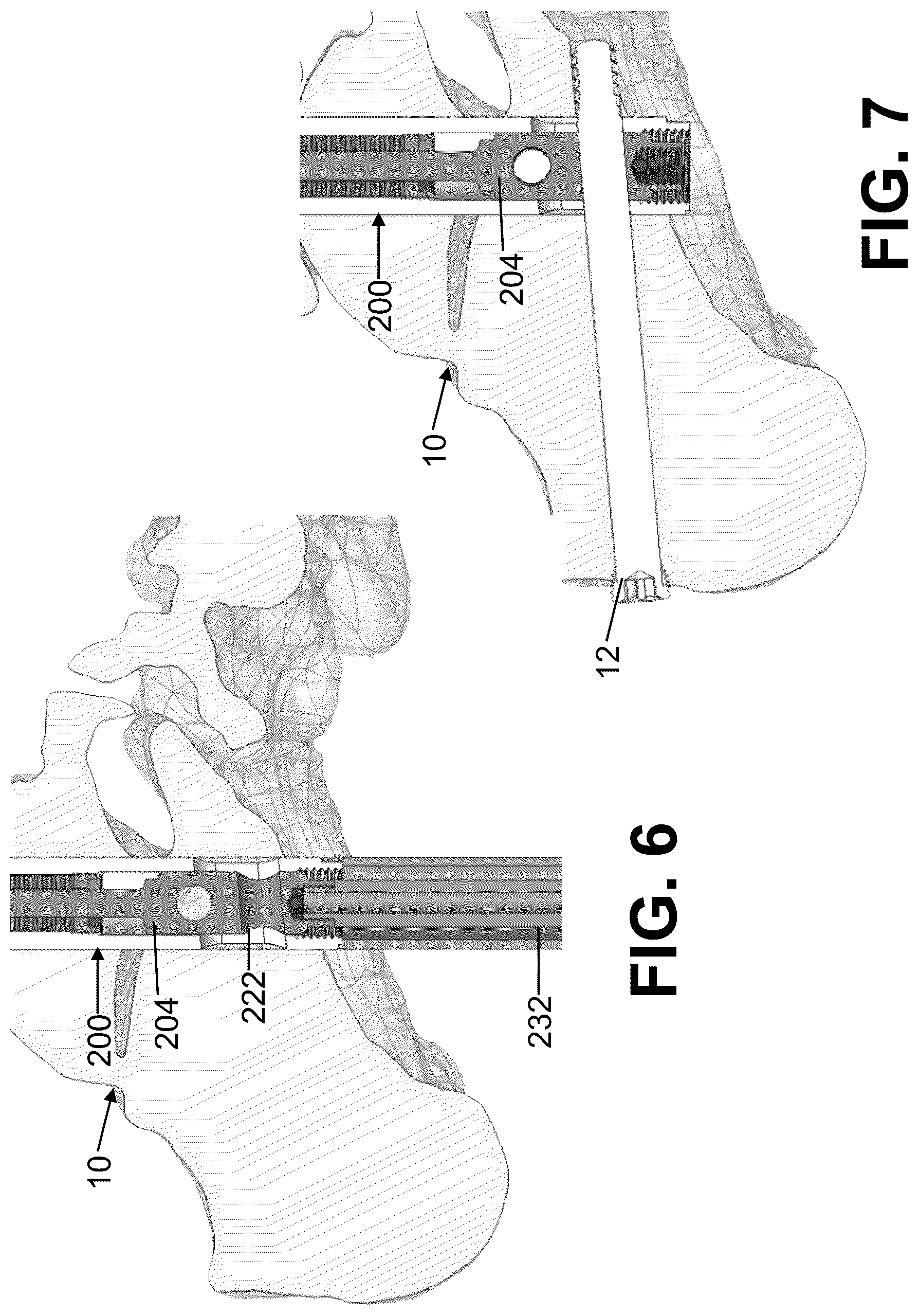 Patent US12611235 Figure 3 – Intramedullary nail with automatic dynamization and continuous compression