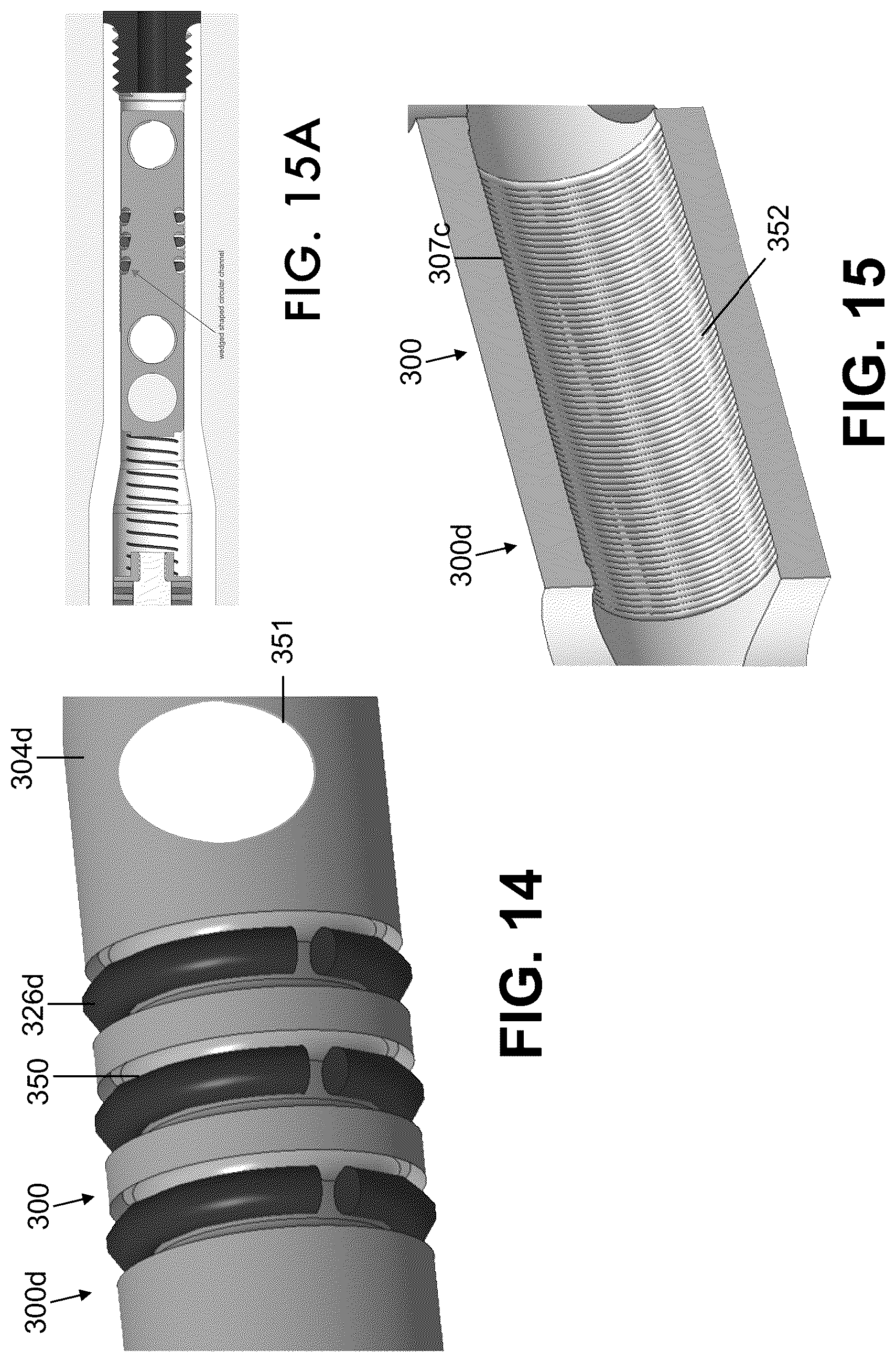 Patent US12611235 Figure 7 – Intramedullary nail with automatic dynamization and continuous compression