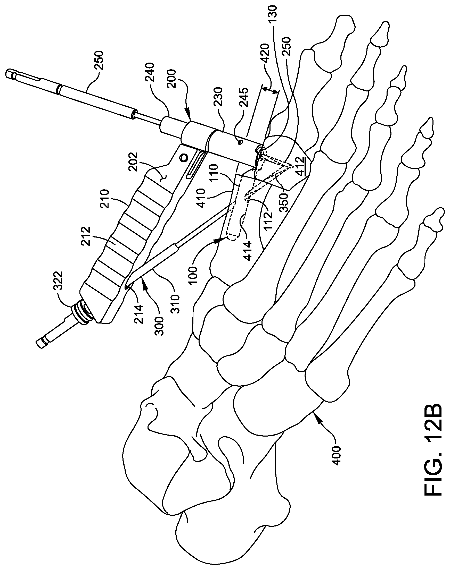 Patent US12611236 Figure 8 – Implant with intramedullary portion and offset extramedullary portion