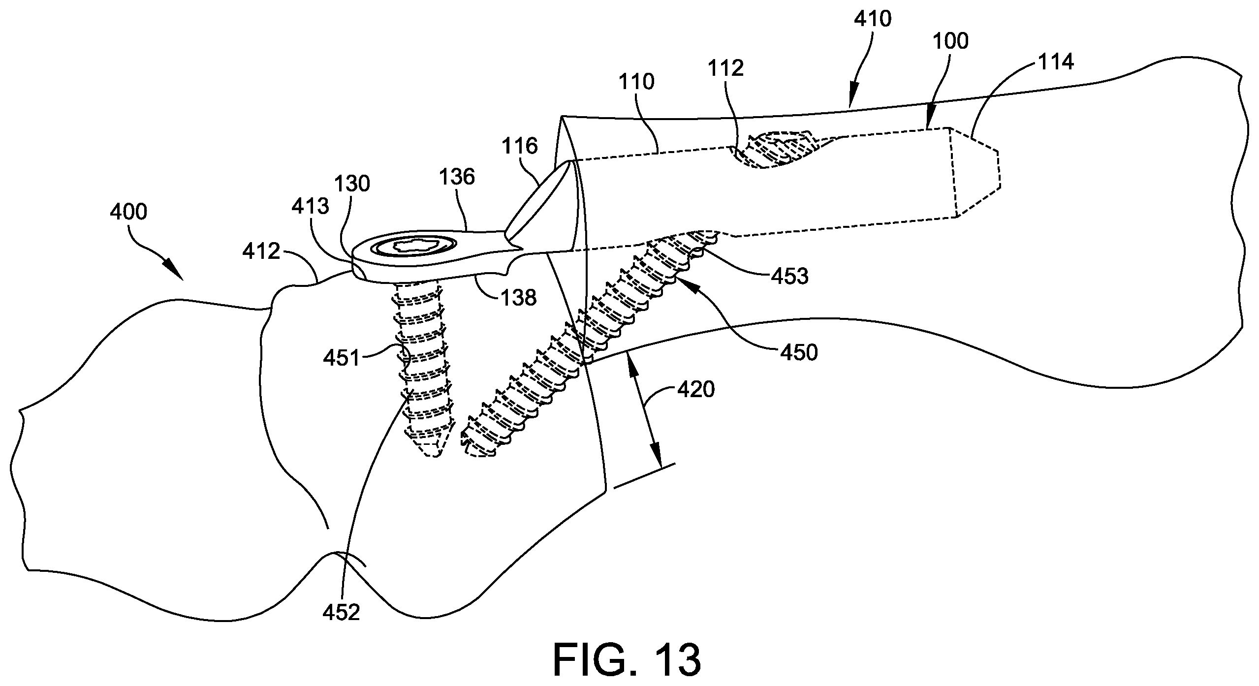 Patent US12611236 Figure 10 – Implant with intramedullary portion and offset extramedullary portion