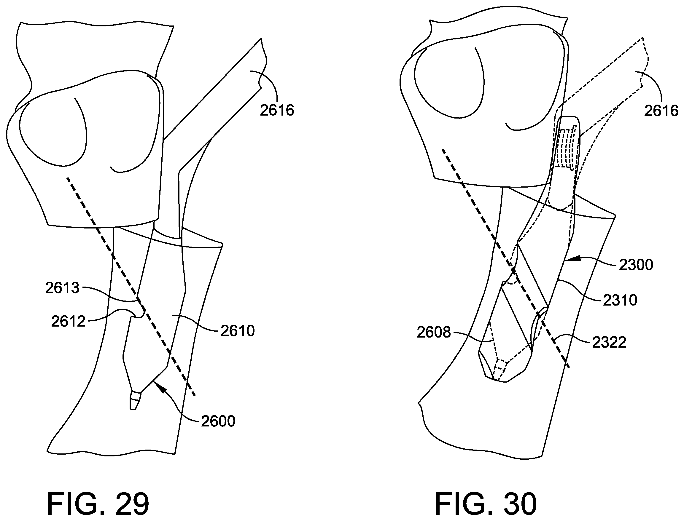 Patent US12611236 Figure 16 – Implant with intramedullary portion and offset extramedullary portion