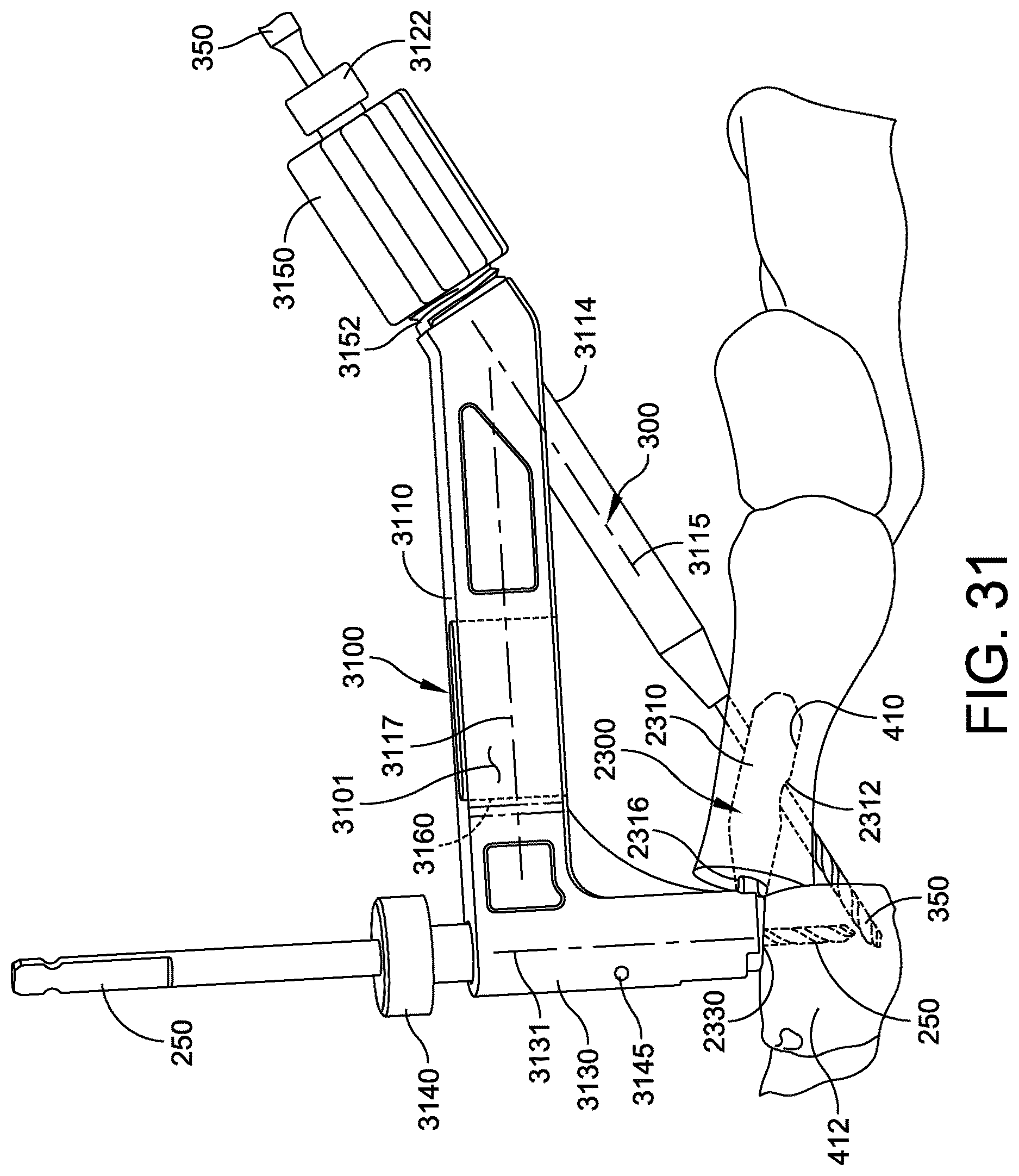 Patent US12611236 Figure 17 – Implant with intramedullary portion and offset extramedullary portion