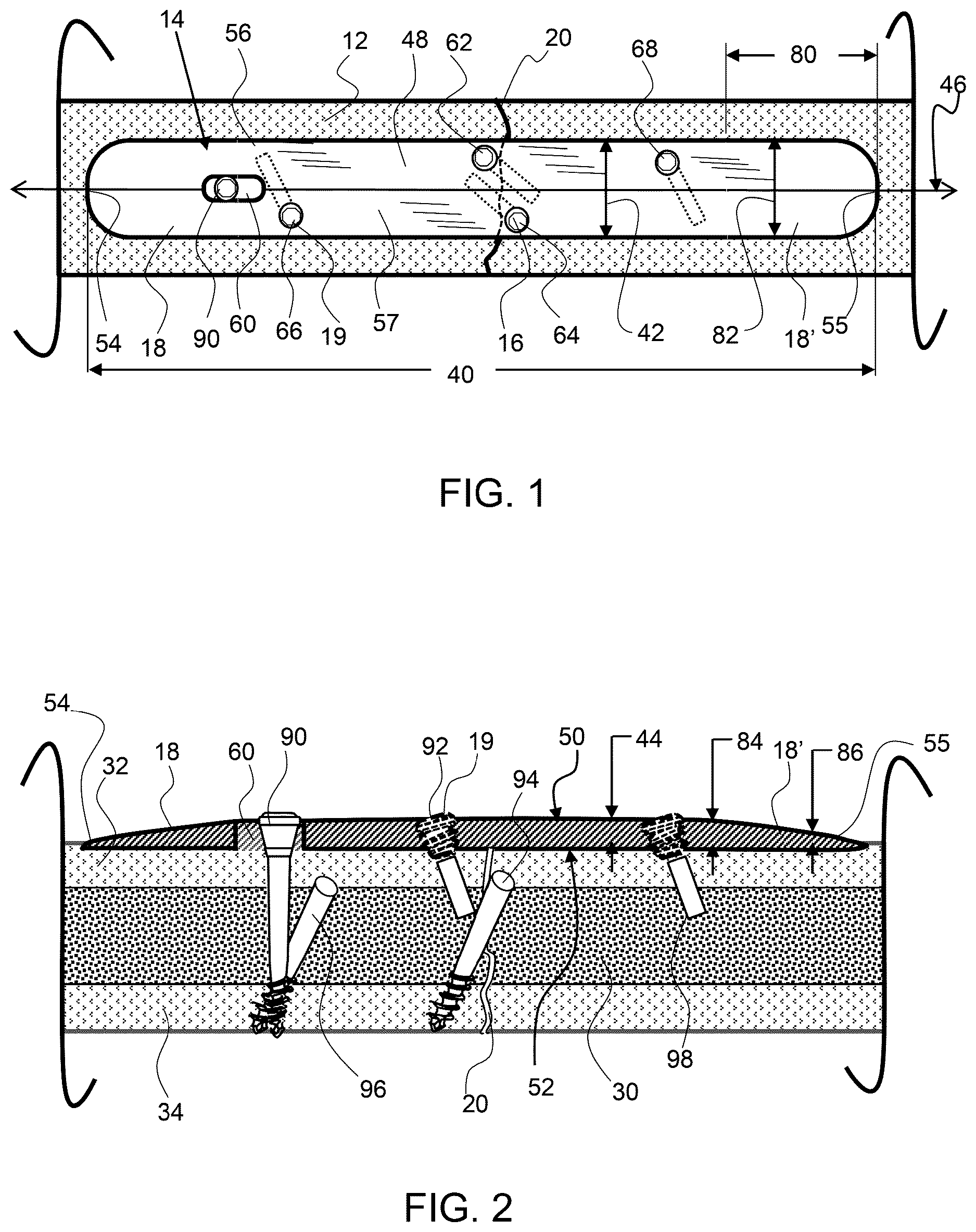 Patent US12611237 Figure 1 – Load sharing bone plate