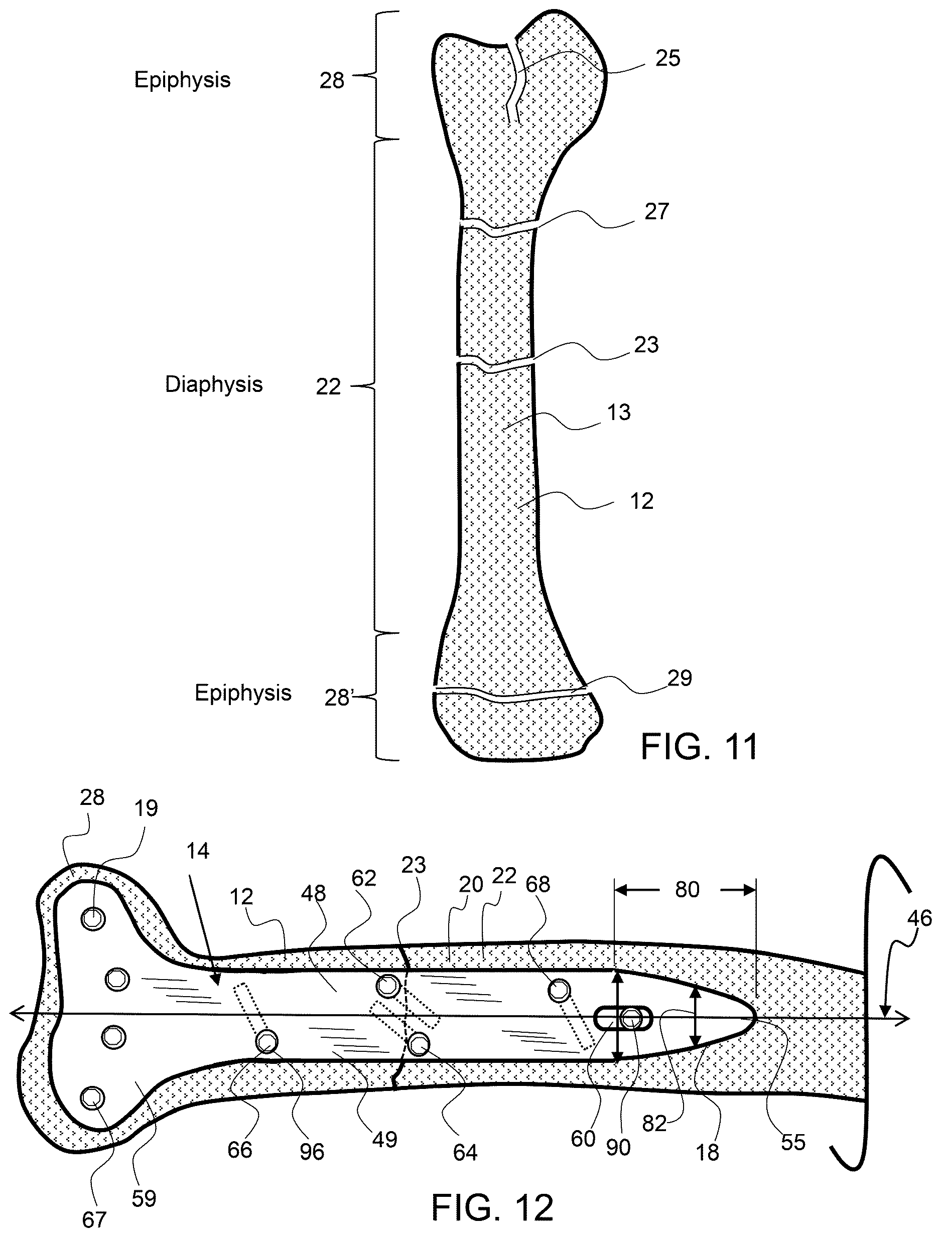 Patent US12611237 Figure 7 – Load sharing bone plate