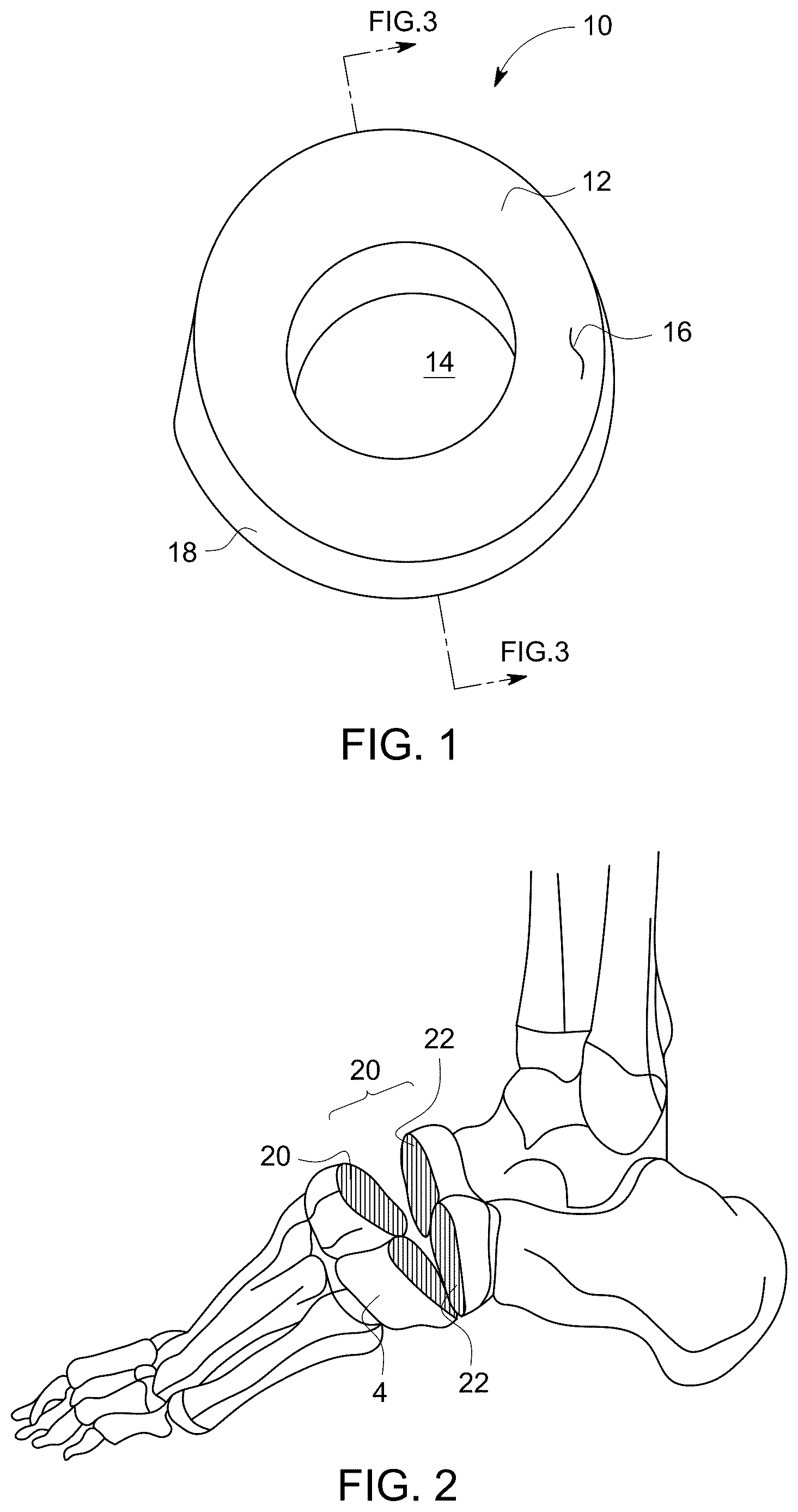 Patent US12611238 Figure 1 – Wedge osteotomy devices, systems, and methods for treating mid-foot disorders