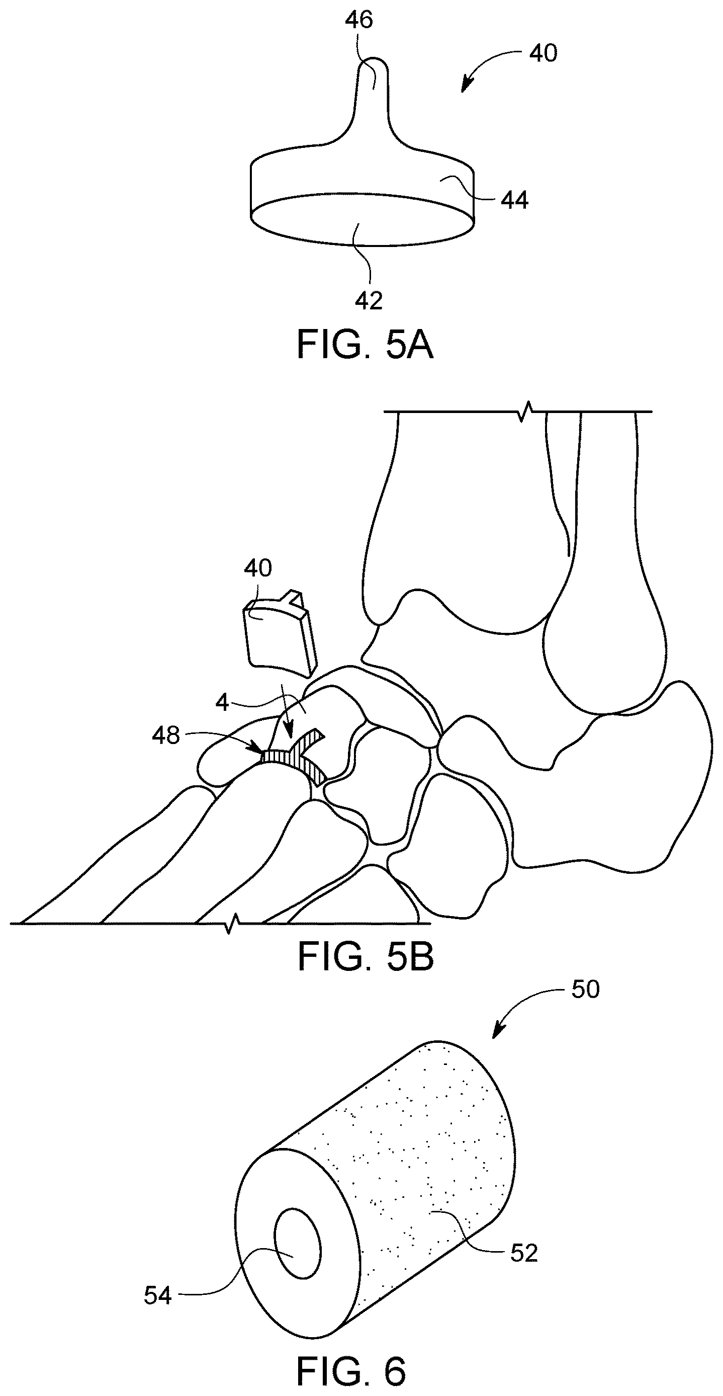 Patent US12611238 Figure 3 – Wedge osteotomy devices, systems, and methods for treating mid-foot disorders