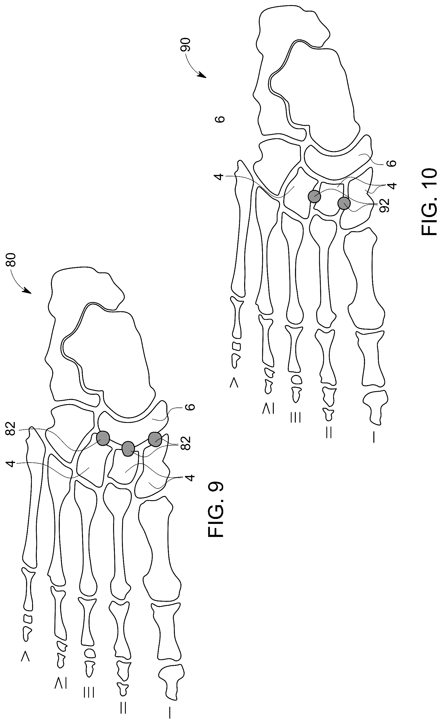 Patent US12611238 Figure 5 – Wedge osteotomy devices, systems, and methods for treating mid-foot disorders