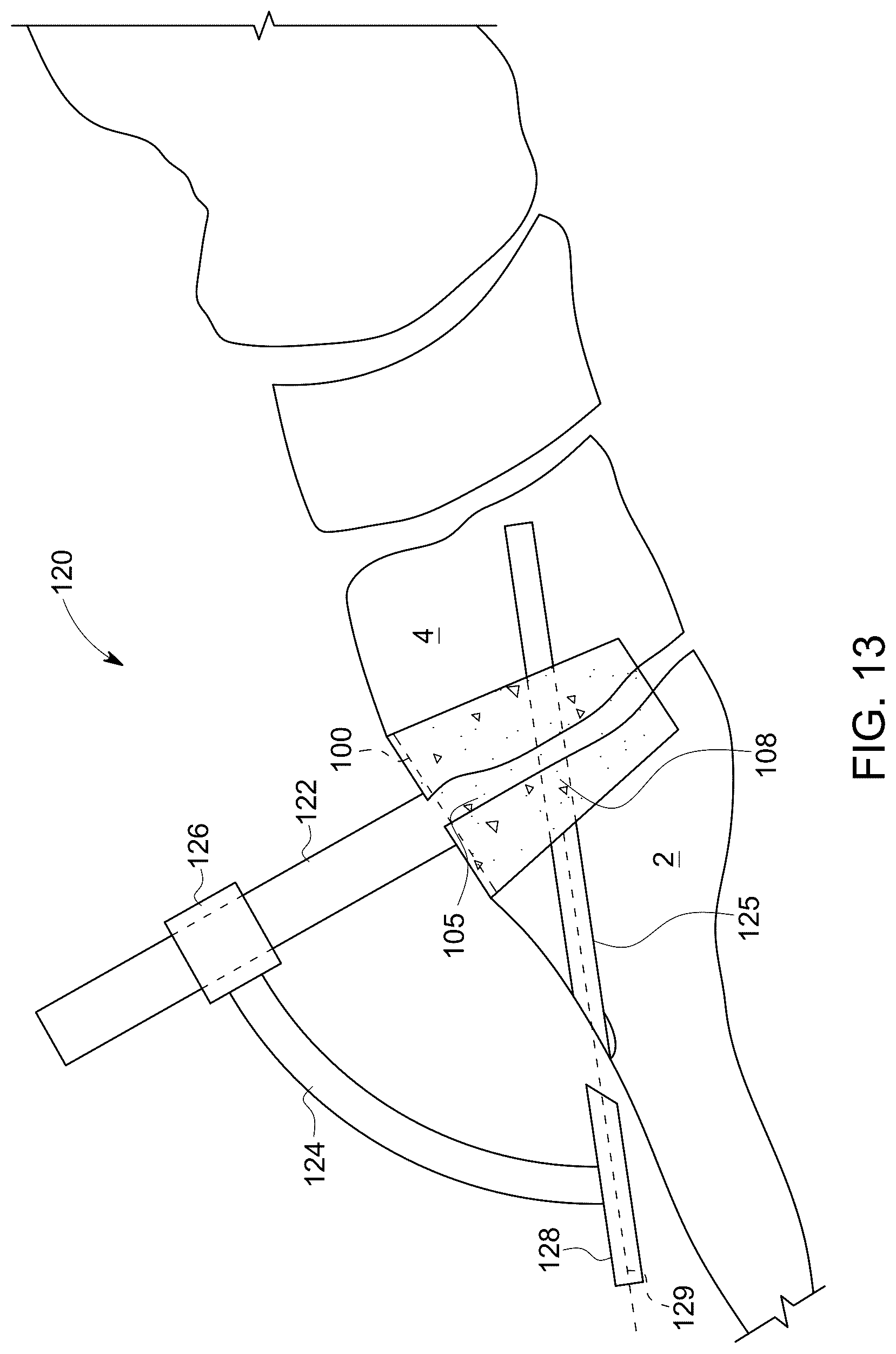 Patent US12611238 Figure 7 – Wedge osteotomy devices, systems, and methods for treating mid-foot disorders