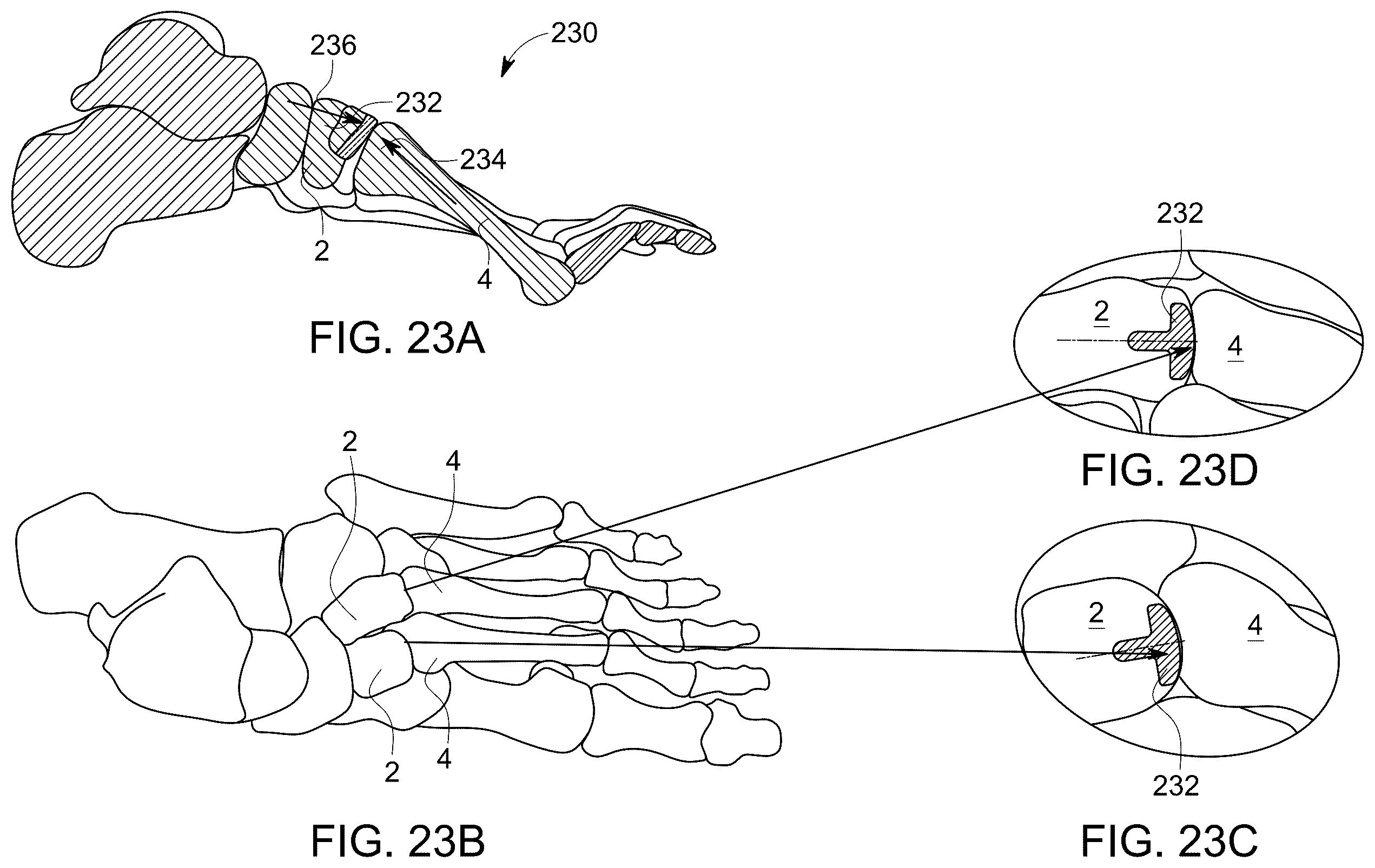 Patent US12611238 Figure 14 – Wedge osteotomy devices, systems, and methods for treating mid-foot disorders