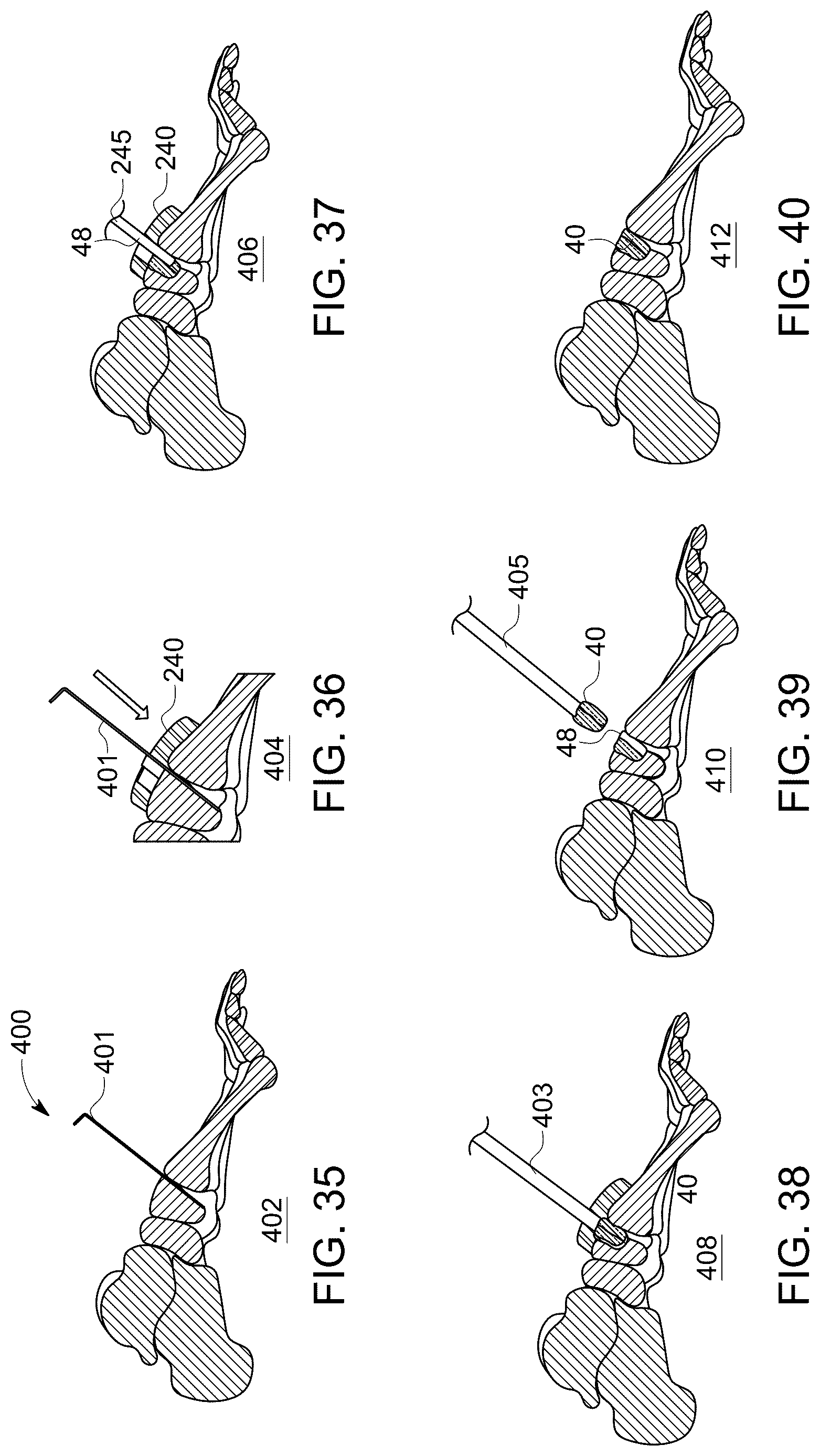 Patent US12611238 Figure 17 – Wedge osteotomy devices, systems, and methods for treating mid-foot disorders