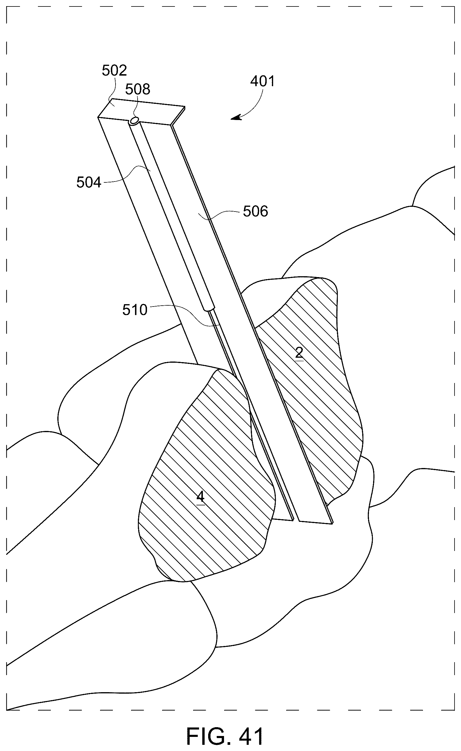 Patent US12611238 Figure 18 – Wedge osteotomy devices, systems, and methods for treating mid-foot disorders