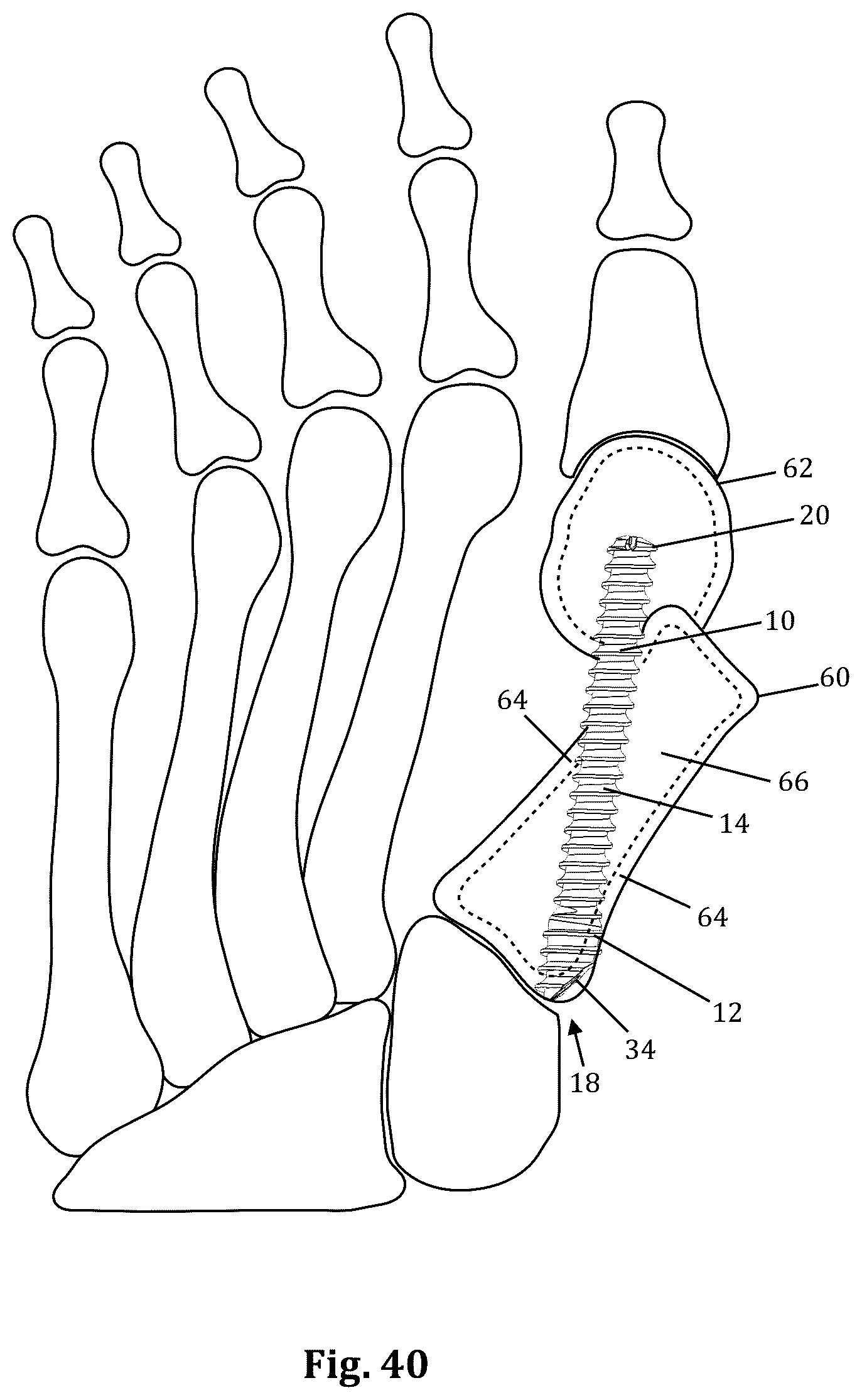 Patent US12611239 Figure 14 – Orthopedic bone screw