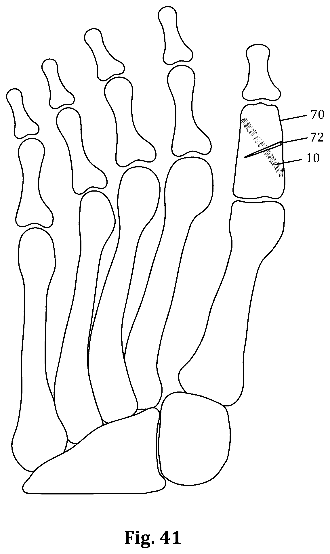 Patent US12611239 Figure 15 – Orthopedic bone screw