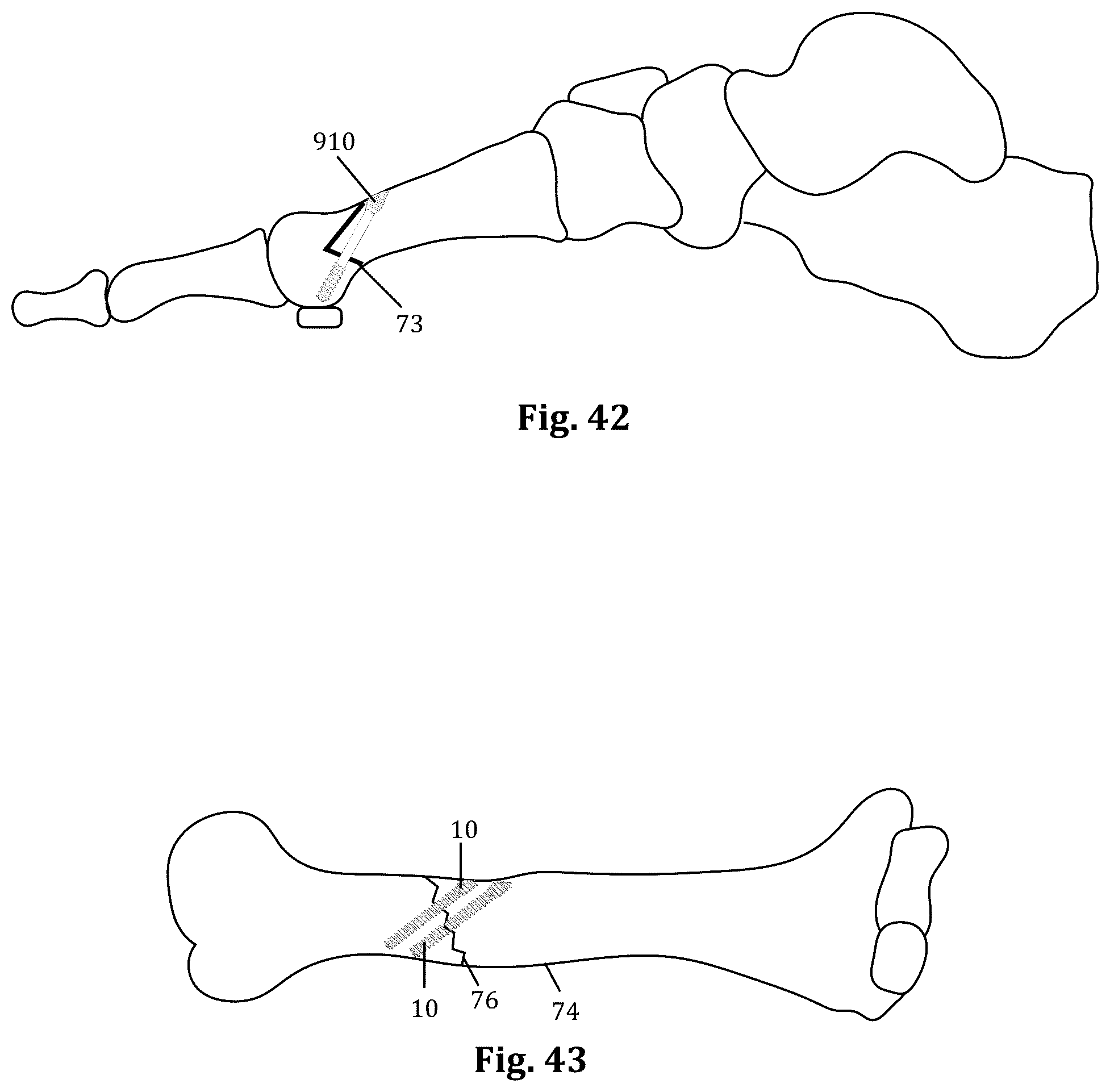 Patent US12611239 Figure 16 – Orthopedic bone screw