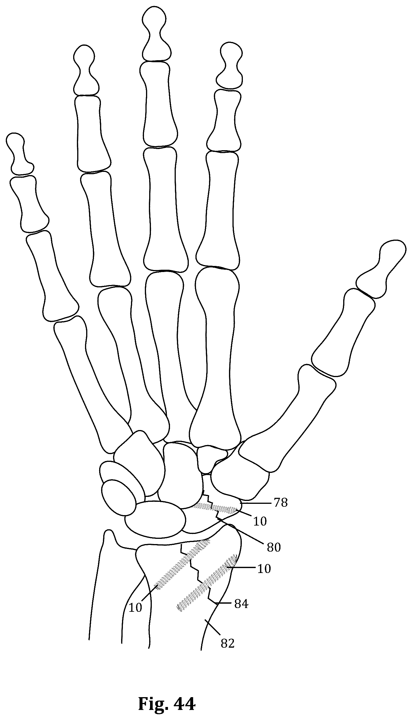 Patent US12611239 Figure 17 – Orthopedic bone screw