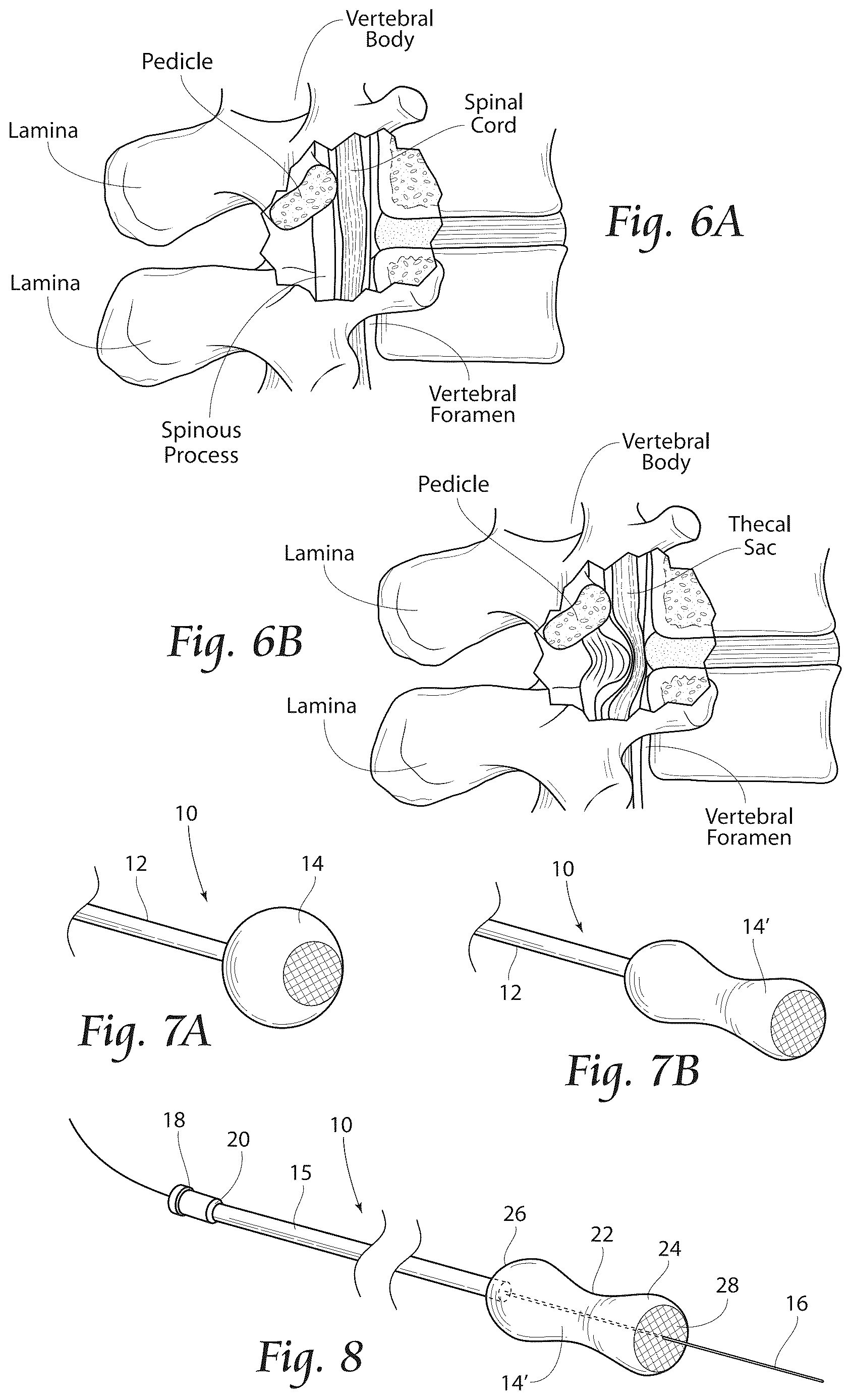 Patent US12611241 Figure 5 – Methods, systems, and devices for the treatment of stenosis