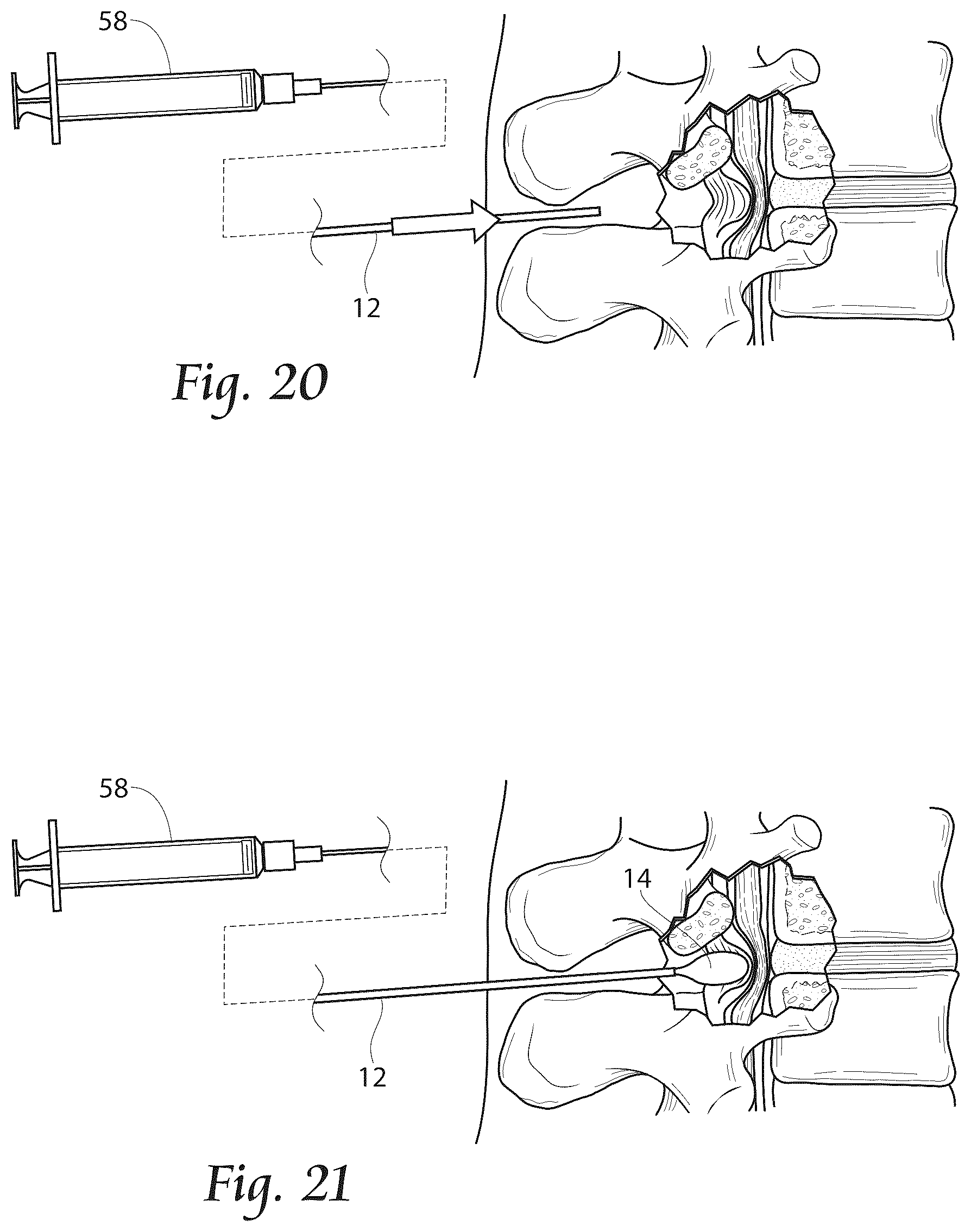 Patent US12611241 Figure 10 – Methods, systems, and devices for the treatment of stenosis