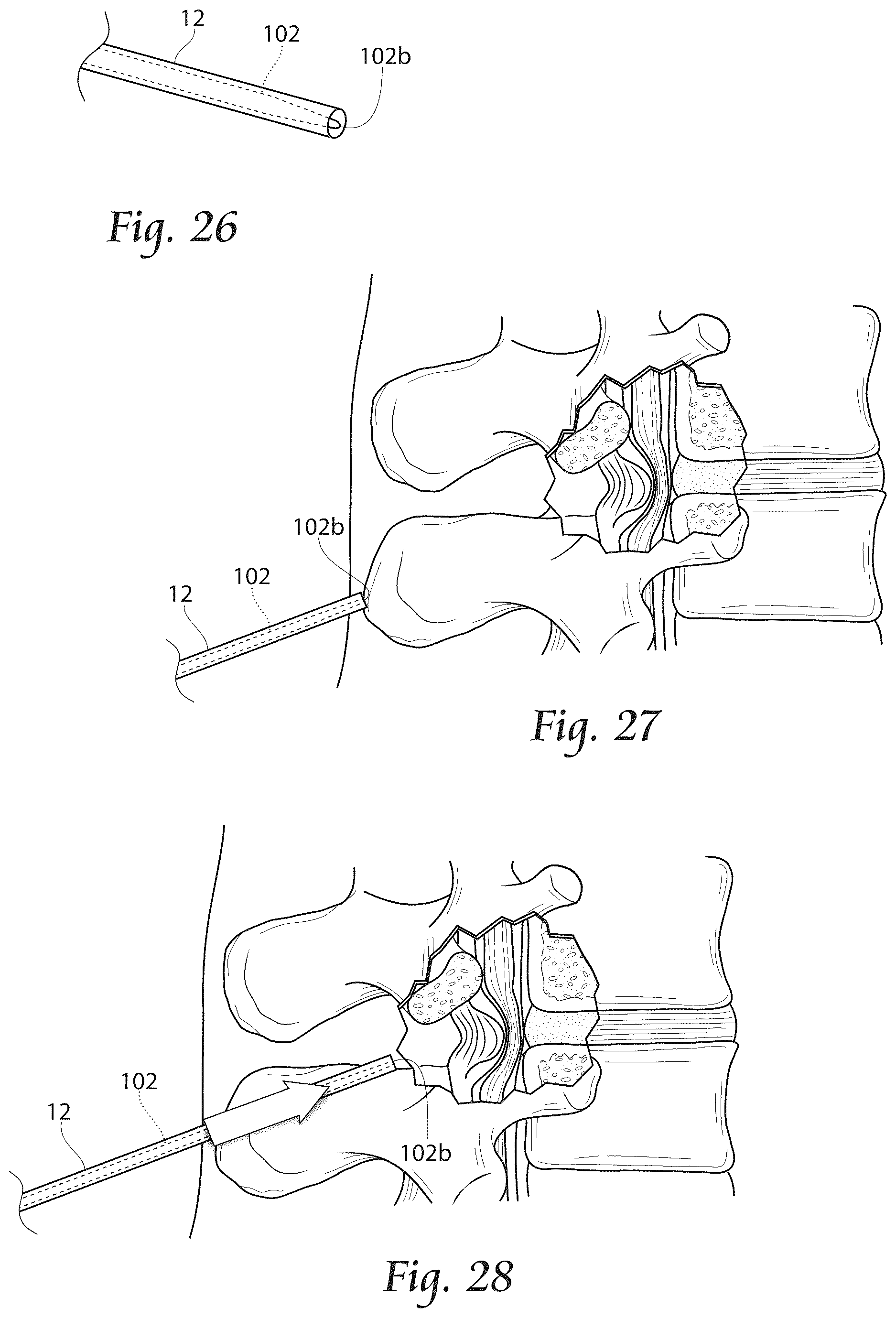 Patent US12611241 Figure 13 – Methods, systems, and devices for the treatment of stenosis