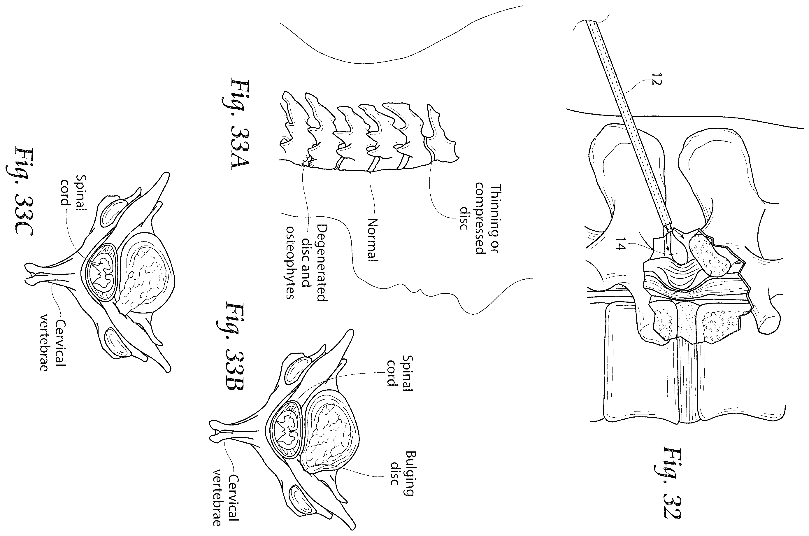 Patent US12611241 Figure 15 – Methods, systems, and devices for the treatment of stenosis