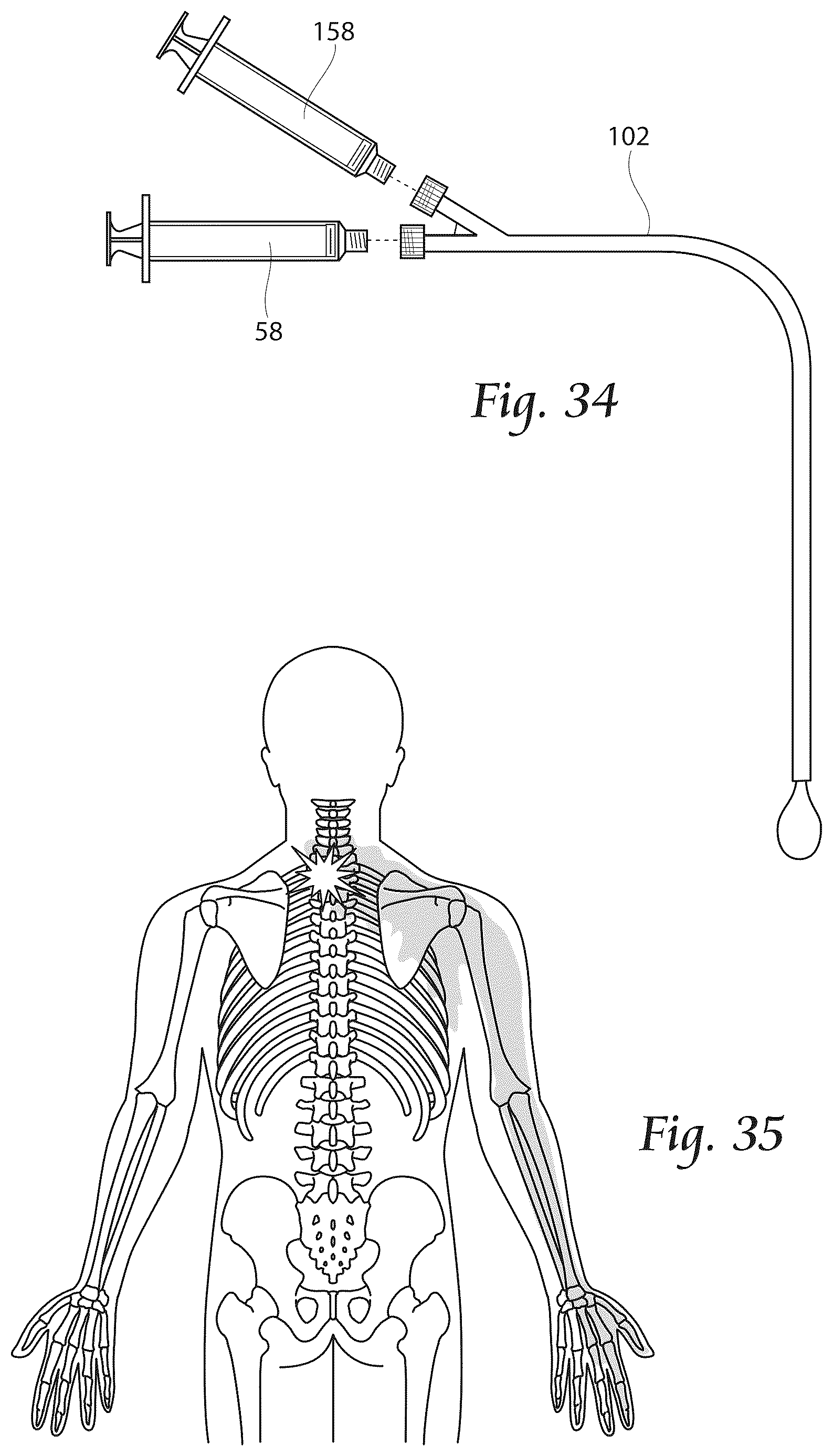 Patent US12611241 Figure 16 – Methods, systems, and devices for the treatment of stenosis