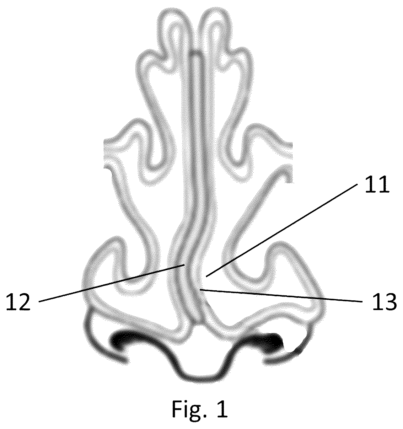 Patent US12611244 Figure 1 – Device and method for treatment of nasal septum