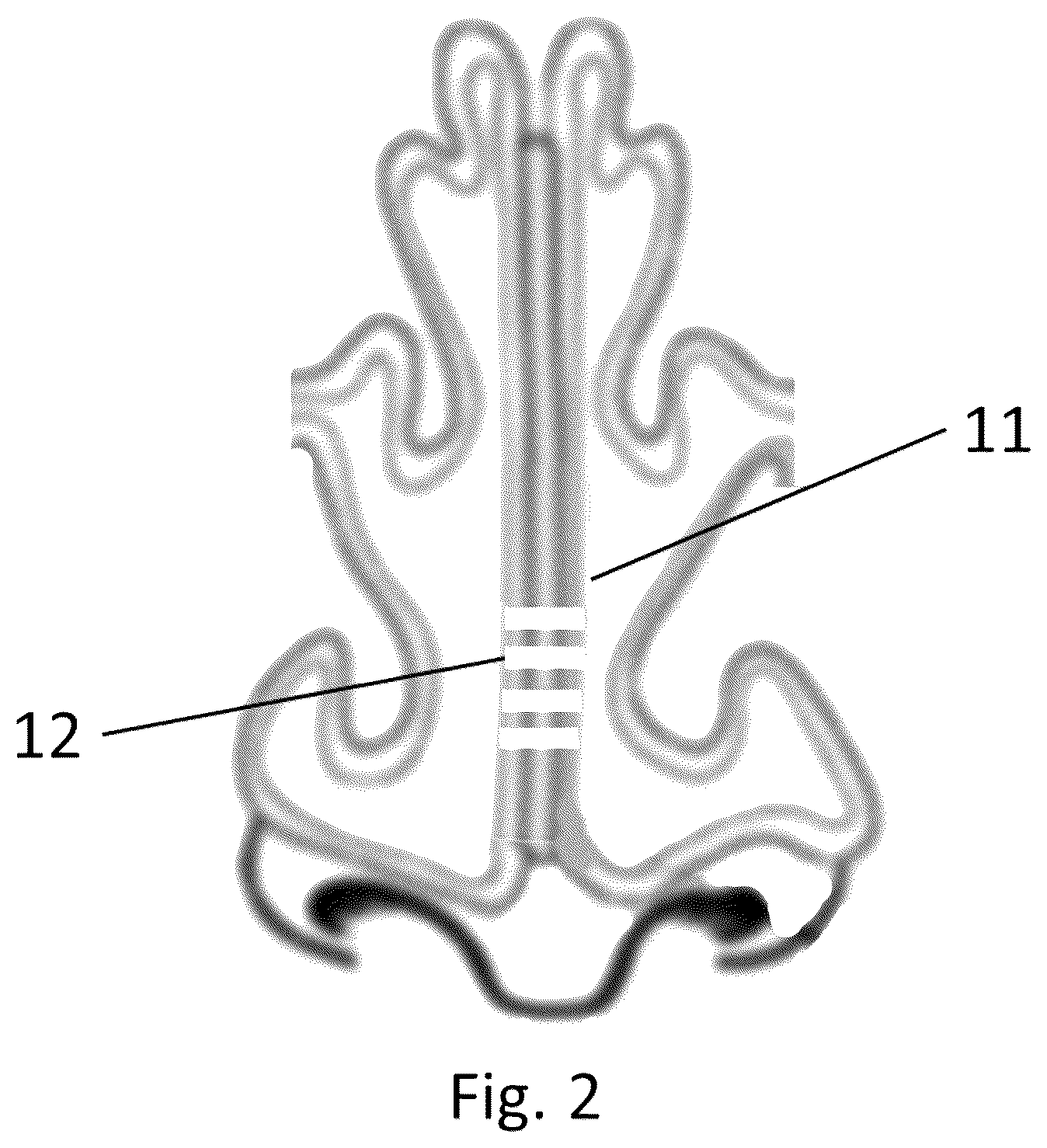 Patent US12611244 Figure 2 – Device and method for treatment of nasal septum