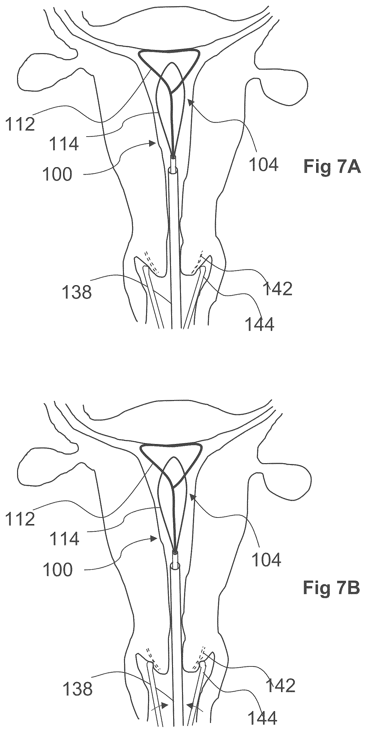 Patent US12611249 Figure 15 – Methods and devices for applying energy to bodily tissues