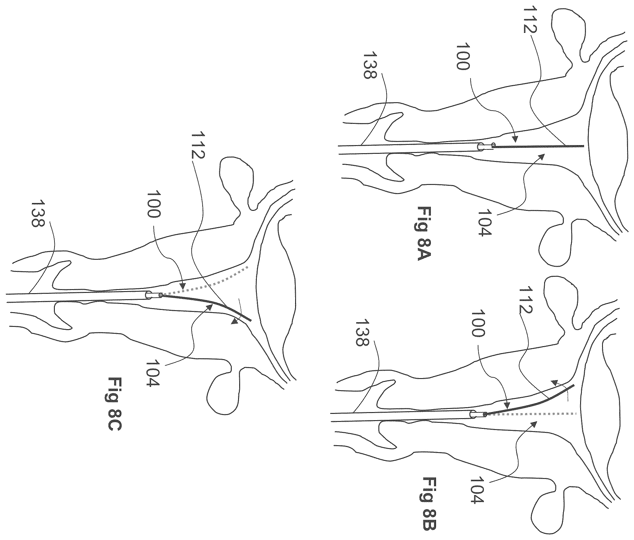 Patent US12611249 Figure 16 – Methods and devices for applying energy to bodily tissues