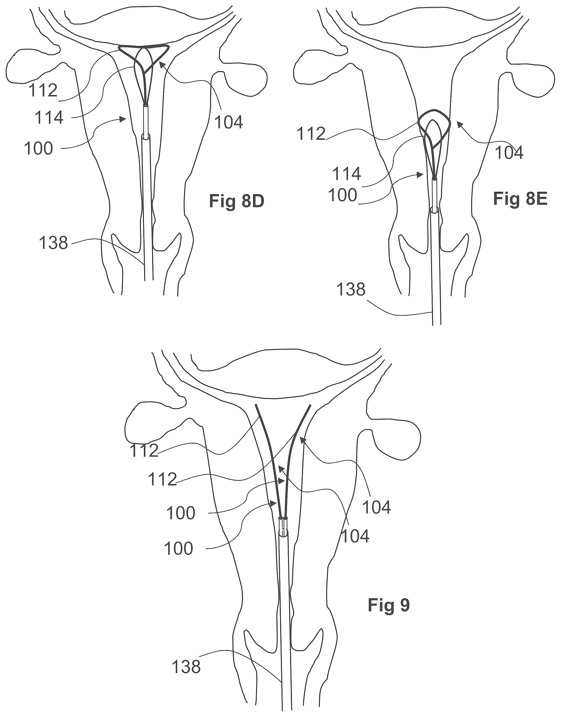 Patent US12611249 Figure 17 – Methods and devices for applying energy to bodily tissues