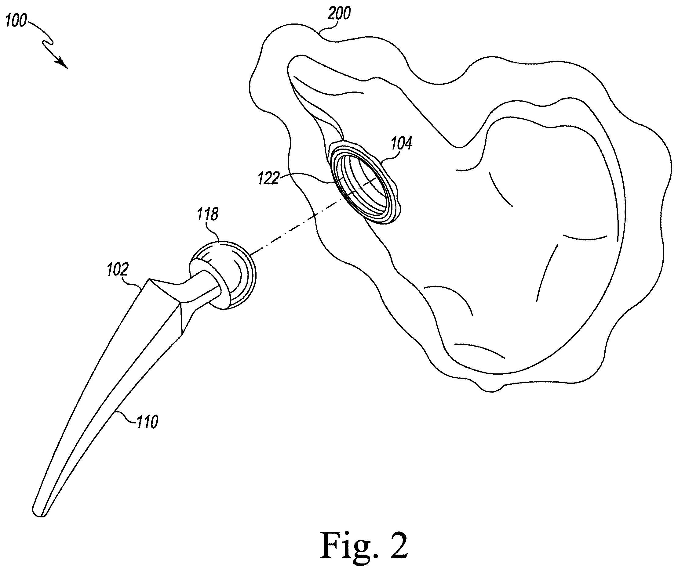 Patent US12611254 Figure 2 – Apparatus, system, and method for determining a position of a hip prosthesis in a bone of a patient